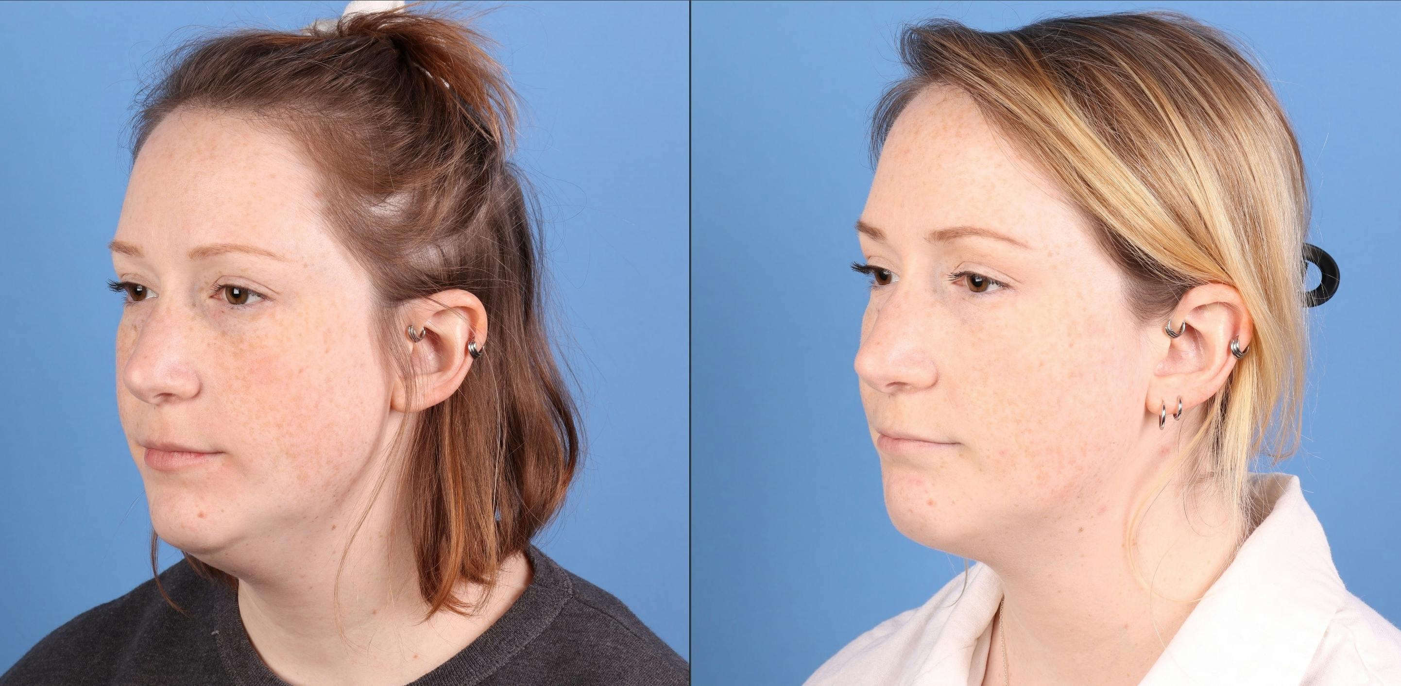 Face & Neck Before & After Gallery - Patient 345880 - Image 2