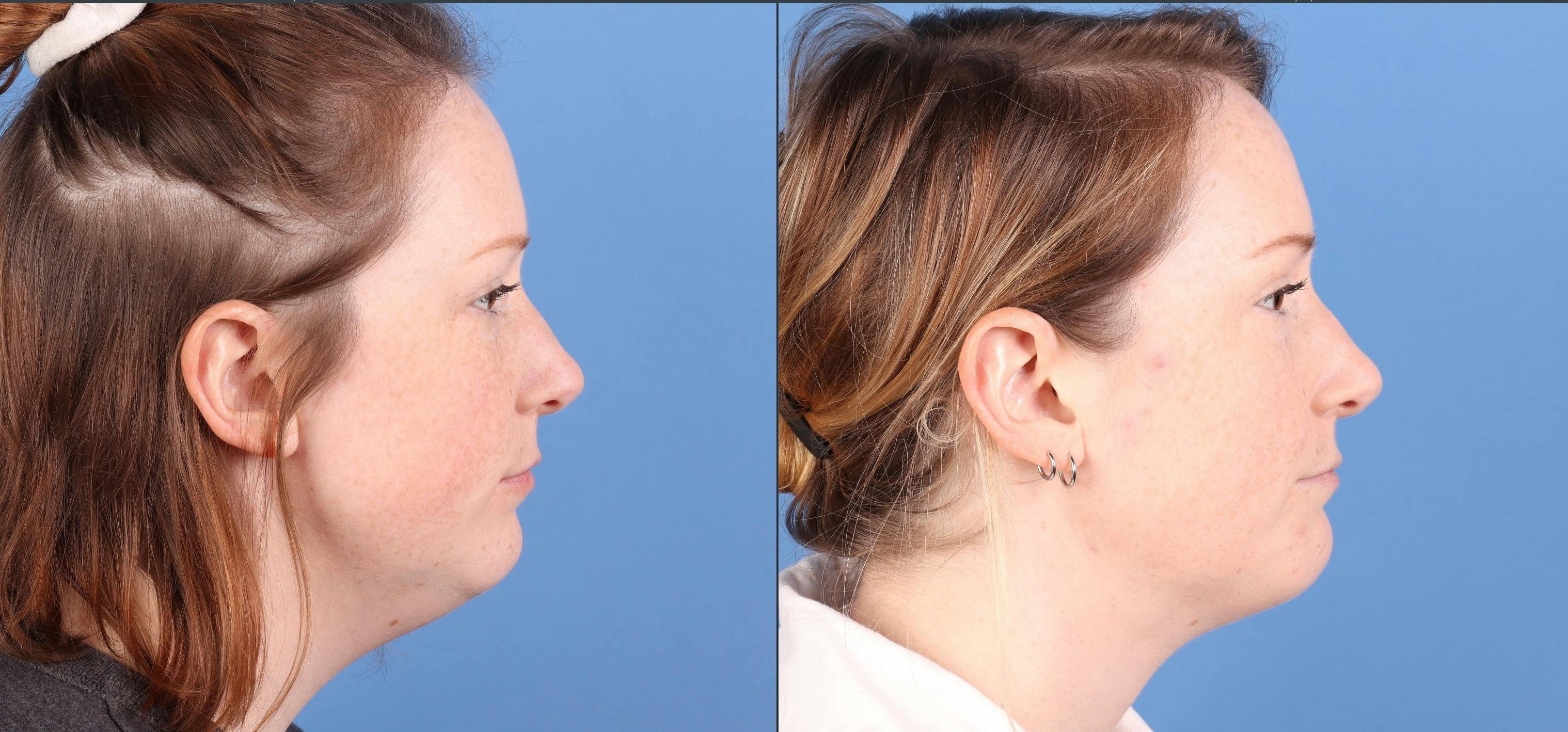 Face & Neck Before & After Gallery - Patient 345880 - Image 5