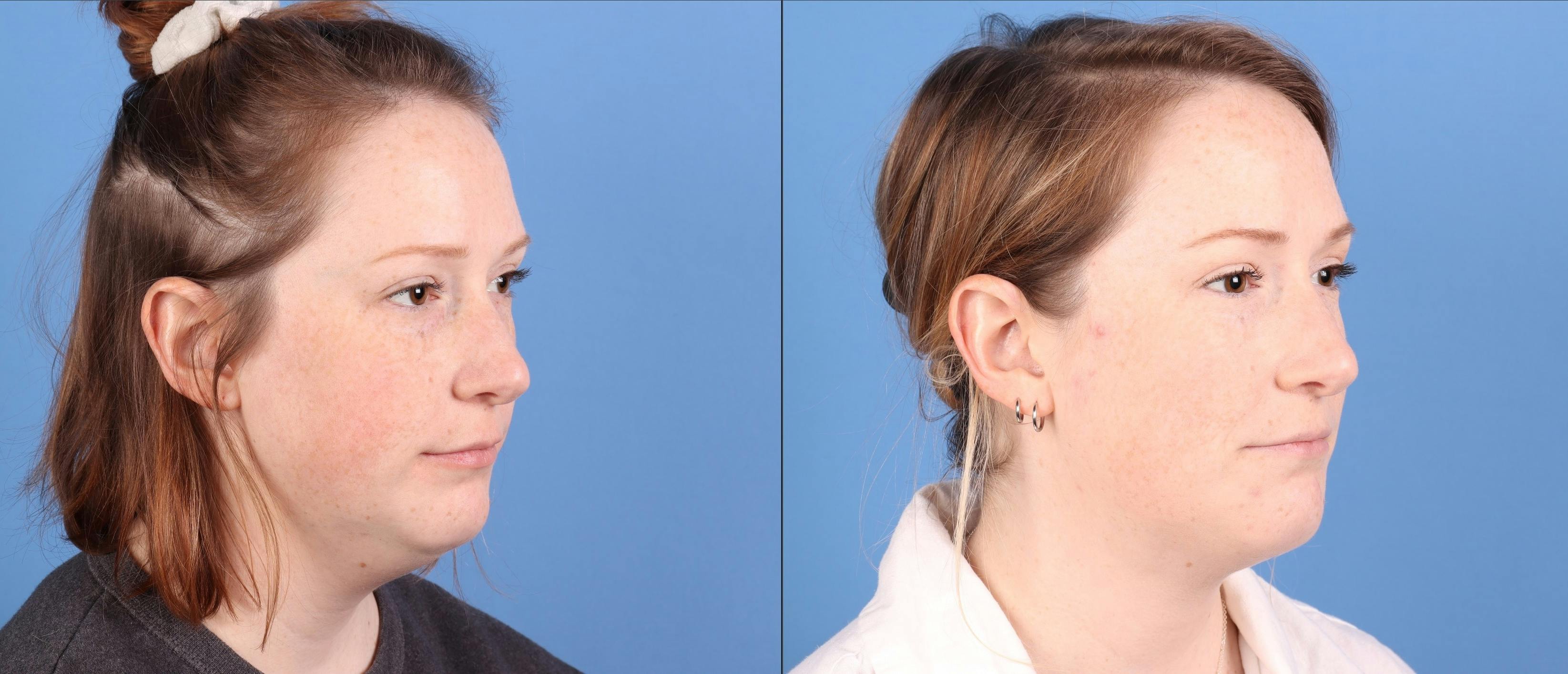 Face & Neck Before & After Gallery - Patient 345880 - Image 4