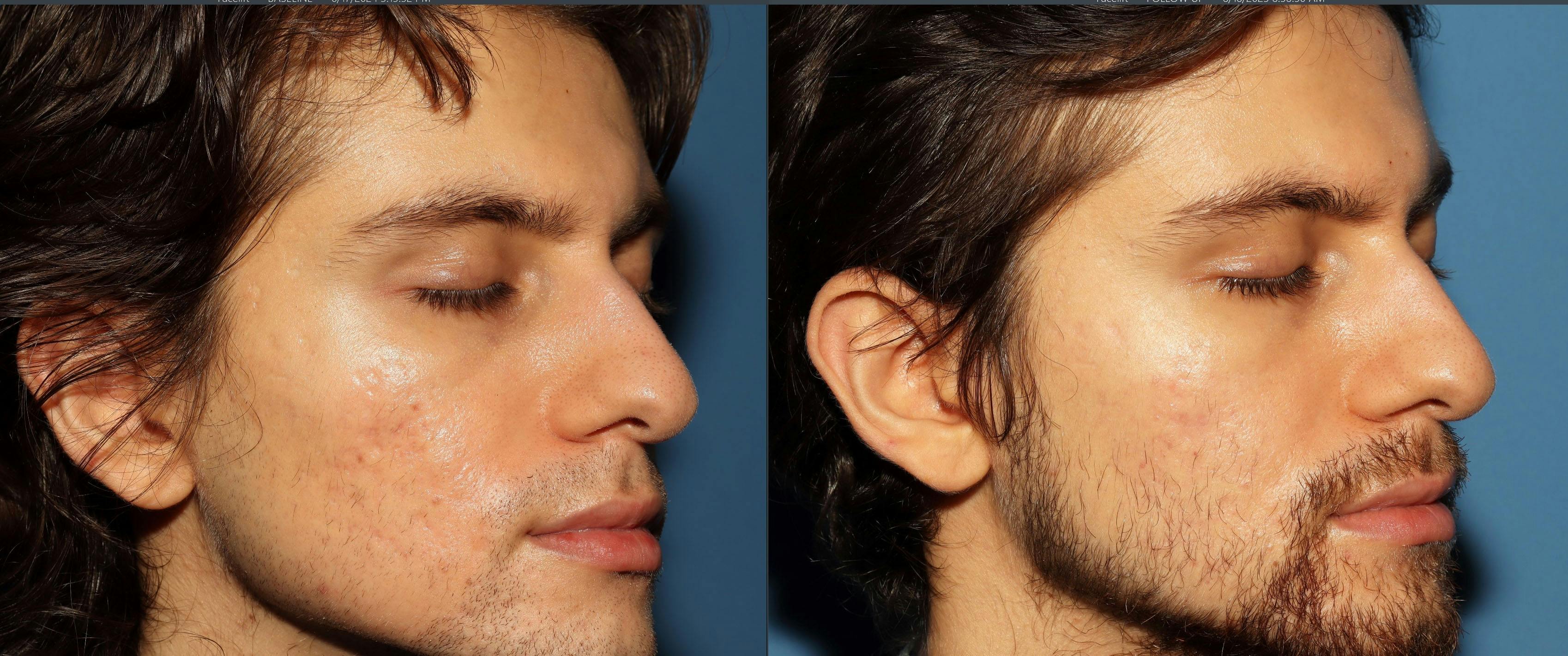 Acne Scar Treatment Before & After Gallery - Patient 115931 - Image 4