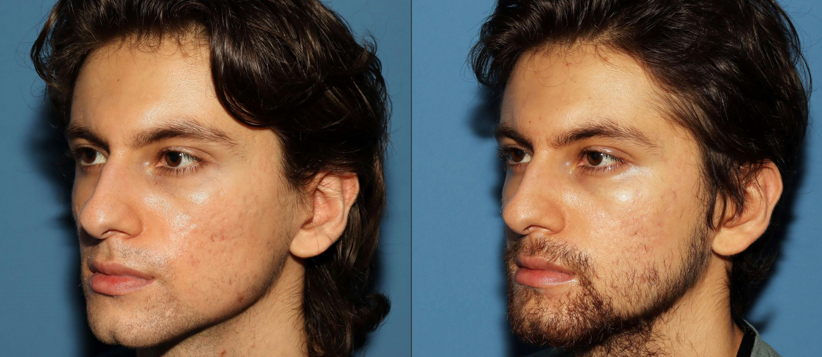 Acne Scar Treatment Before & After Gallery - Patient 115931 - Image 5