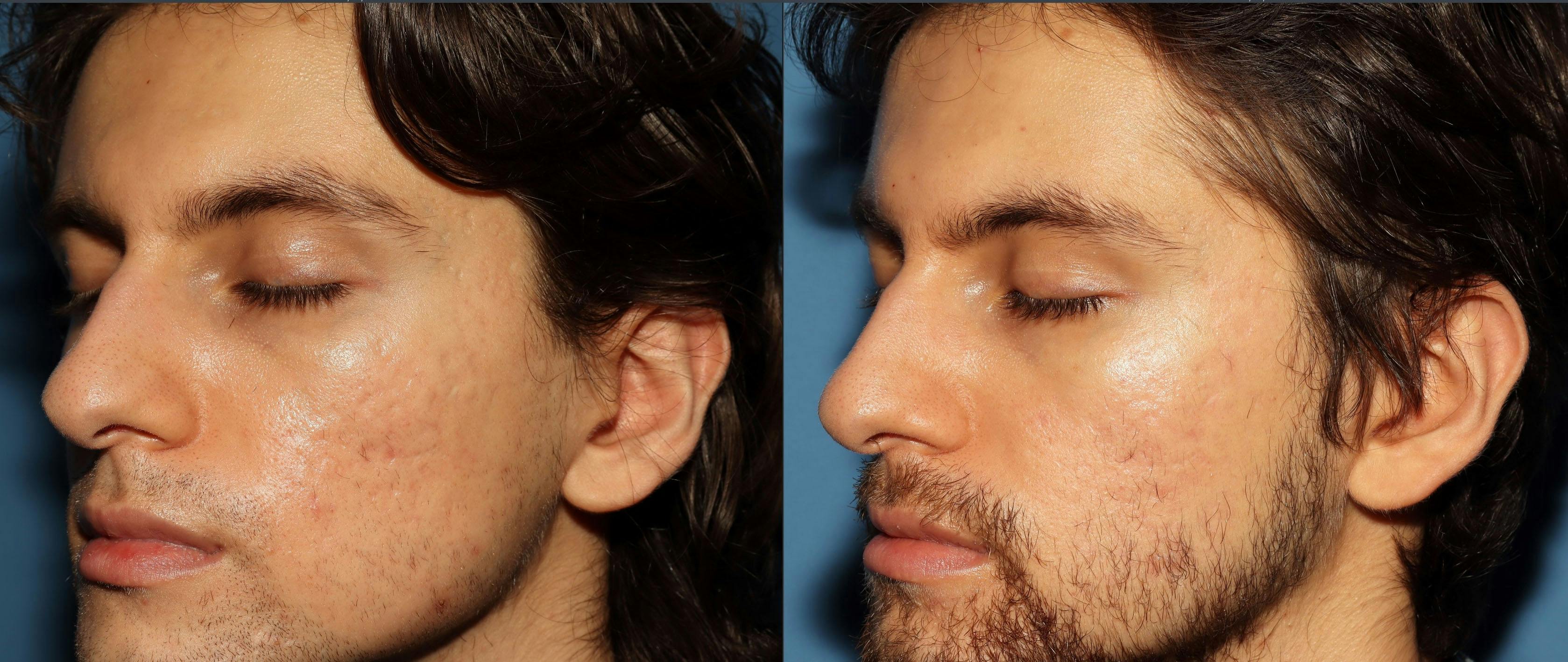 Acne Scar Treatment Before & After Gallery - Patient 115931 - Image 7