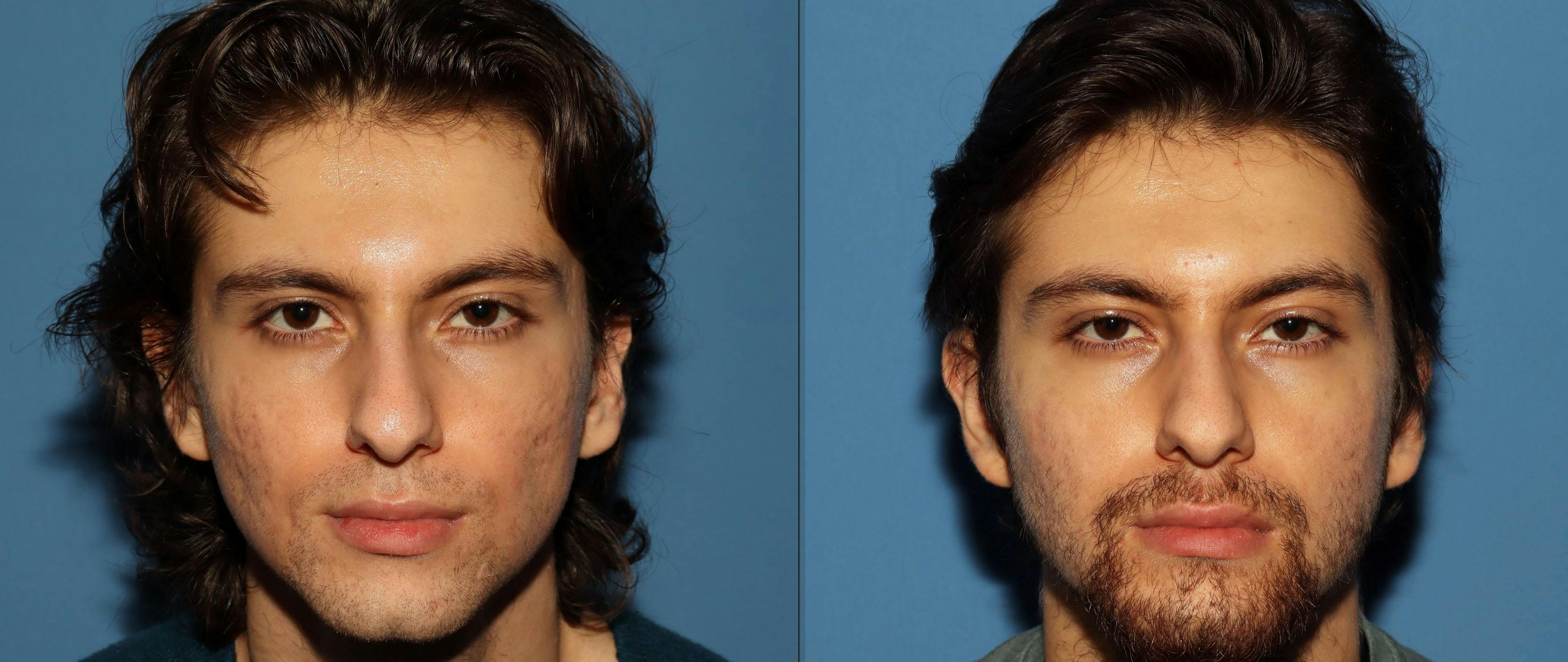 Acne Scar Treatment Before & After Gallery - Patient 115931 - Image 1