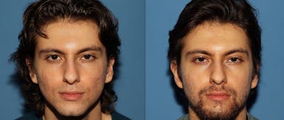 Contour TRL Laser Before & After Gallery - Patient 186876 - Image 1
