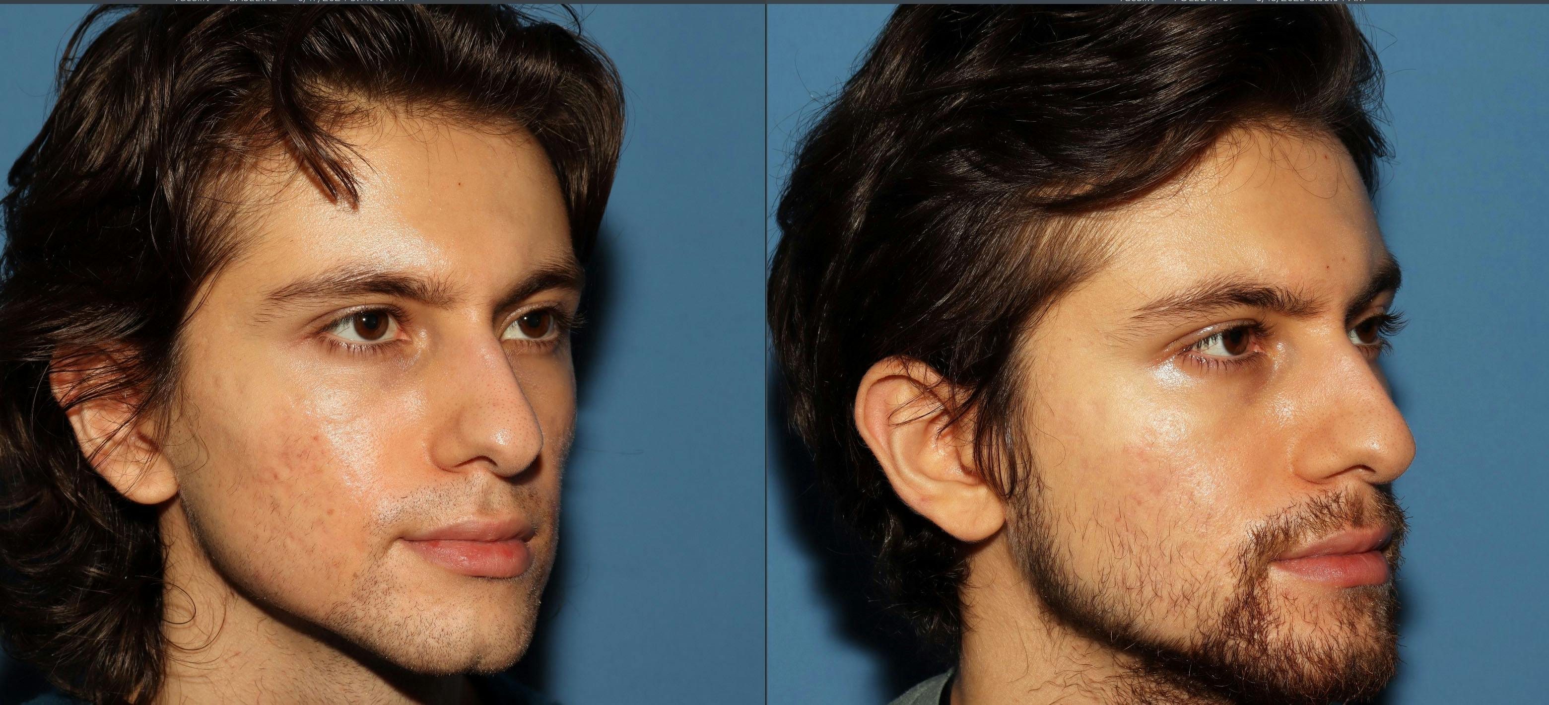Acne Scar Treatment Before & After Gallery - Patient 115931 - Image 2