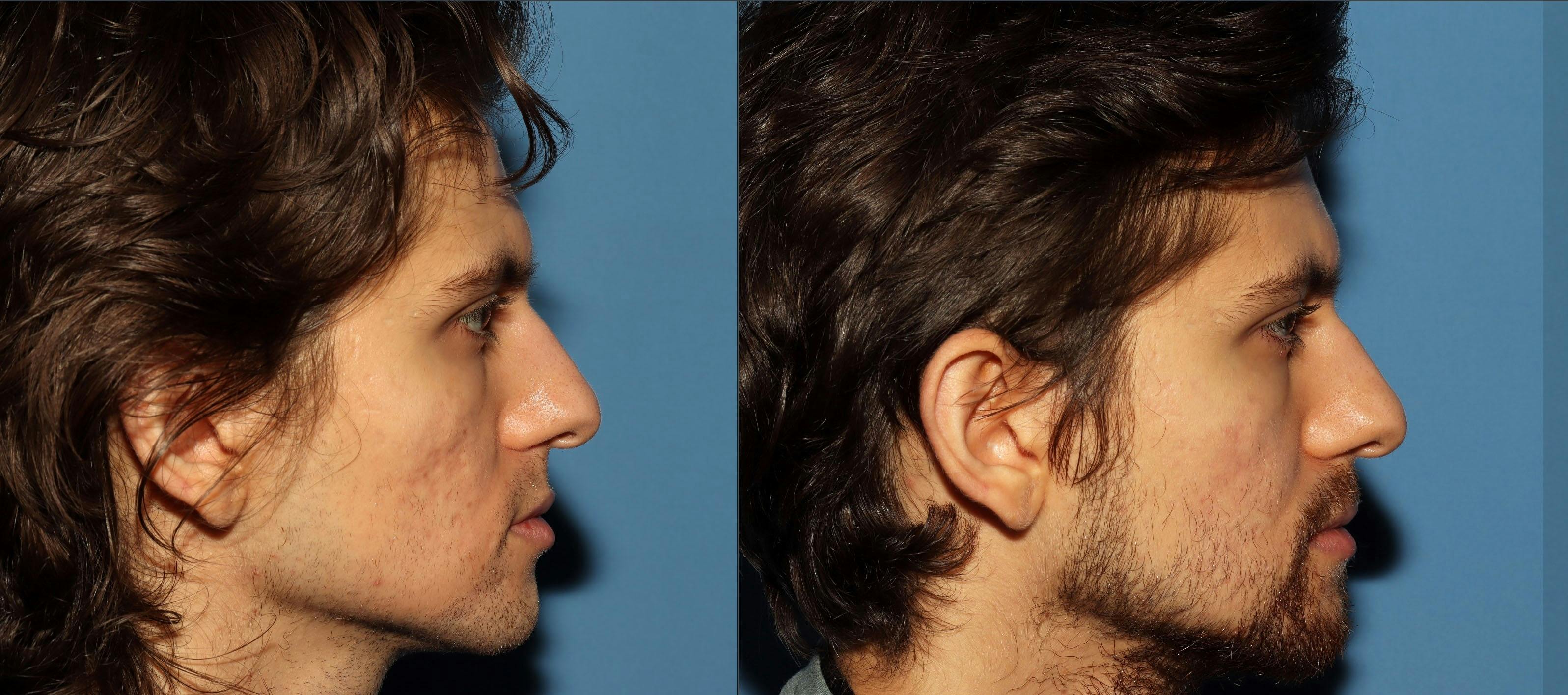 Acne Scar Treatment Before & After Gallery - Patient 115931 - Image 3