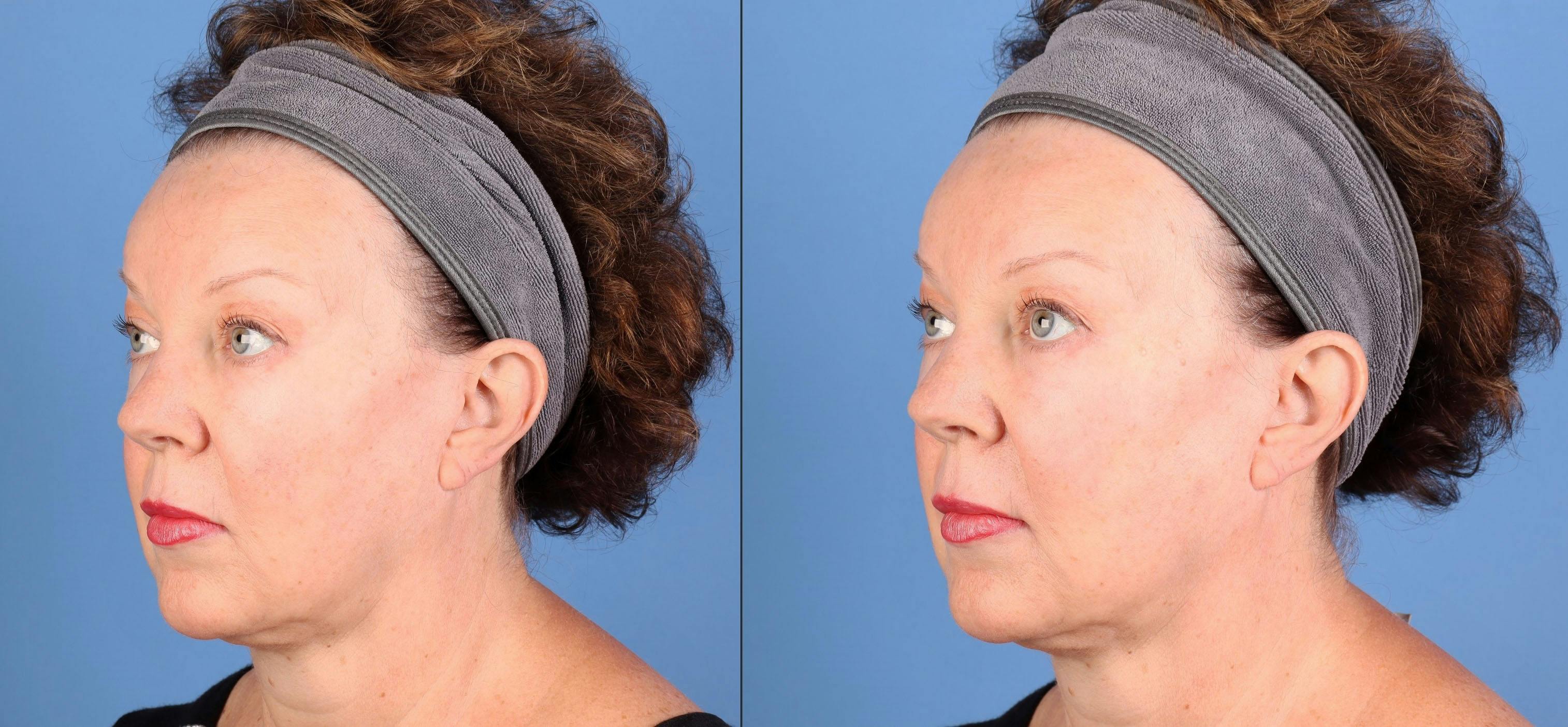 Facial Fillers Before & After Gallery - Patient 340075 - Image 3