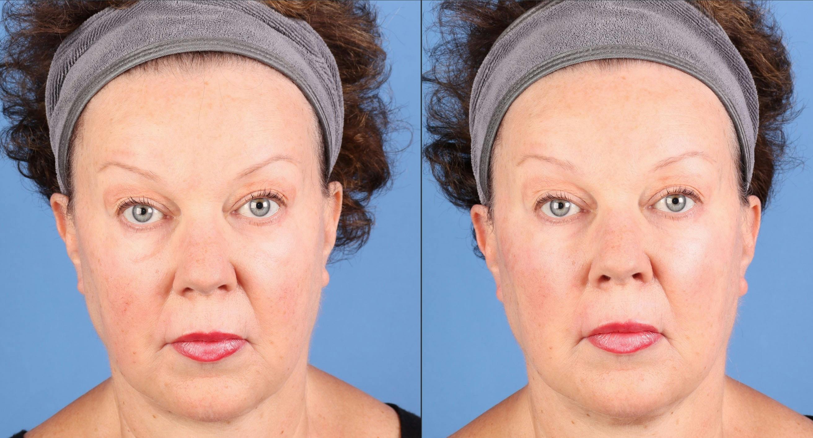 Facial Fillers Before & After Gallery - Patient 340075 - Image 1