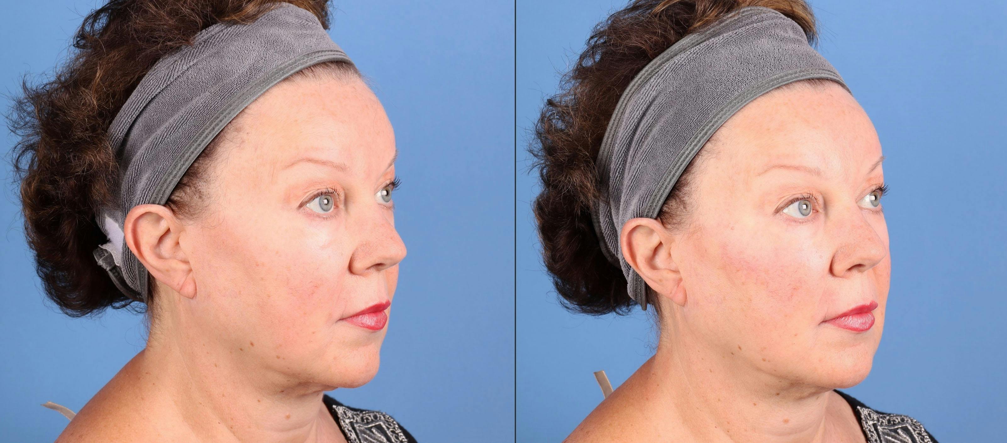 Facial Fillers Before & After Gallery - Patient 340075 - Image 2