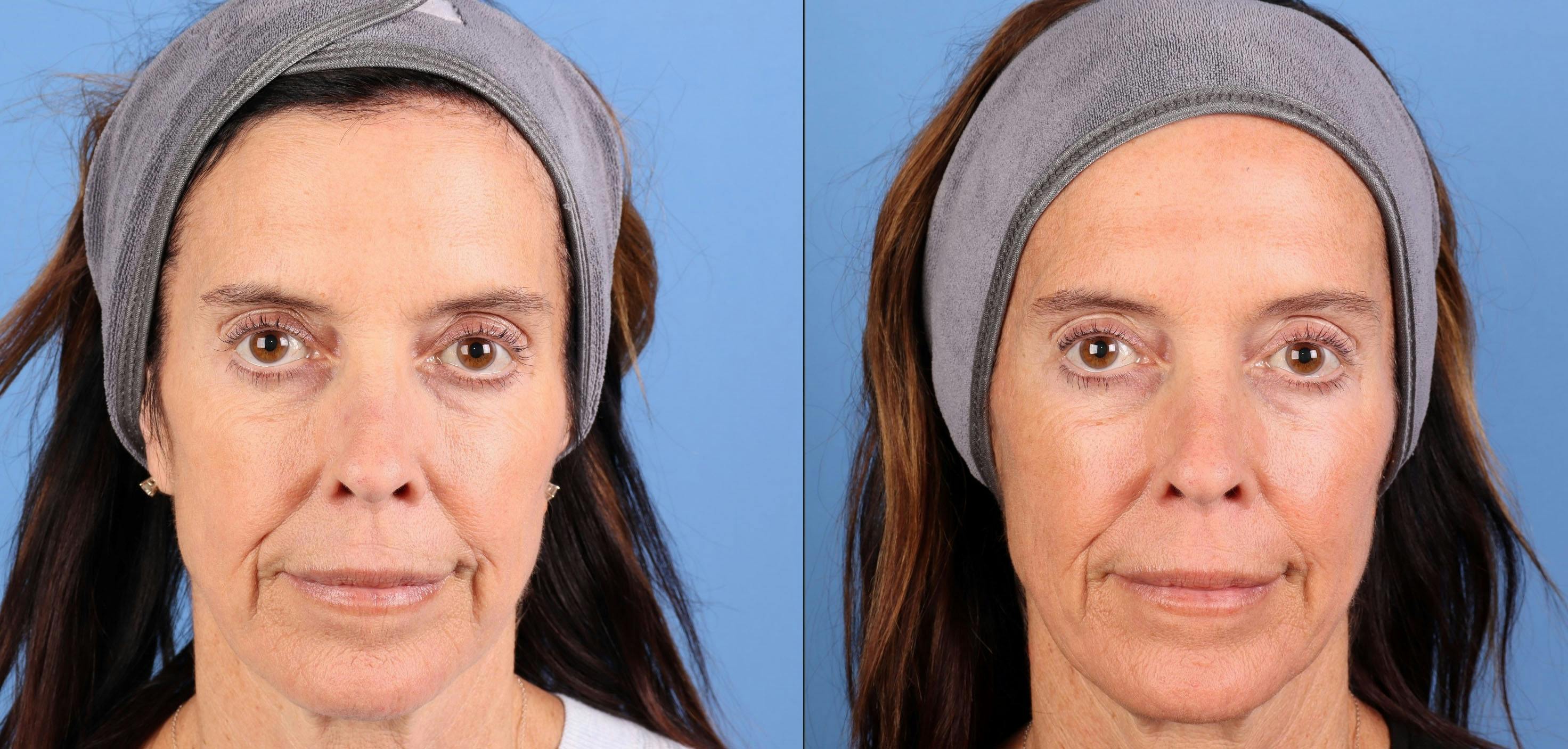 Laser Treatments Before & After Gallery - Patient 394617 - Image 1
