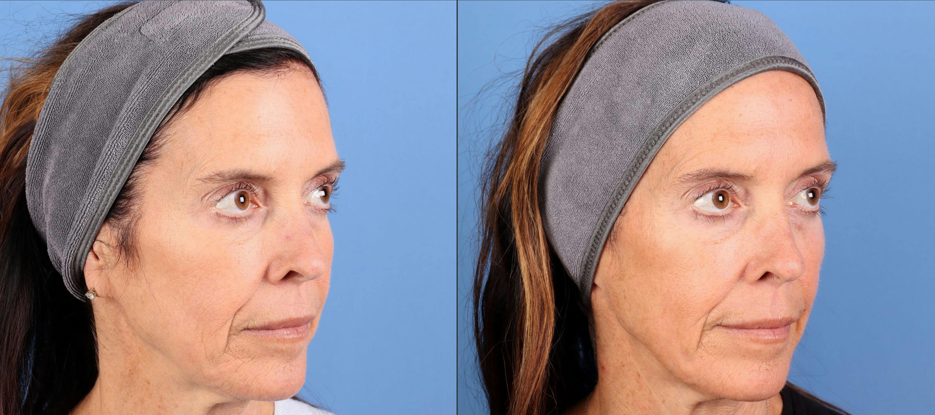 Laser Treatments Before & After Gallery - Patient 394617 - Image 2