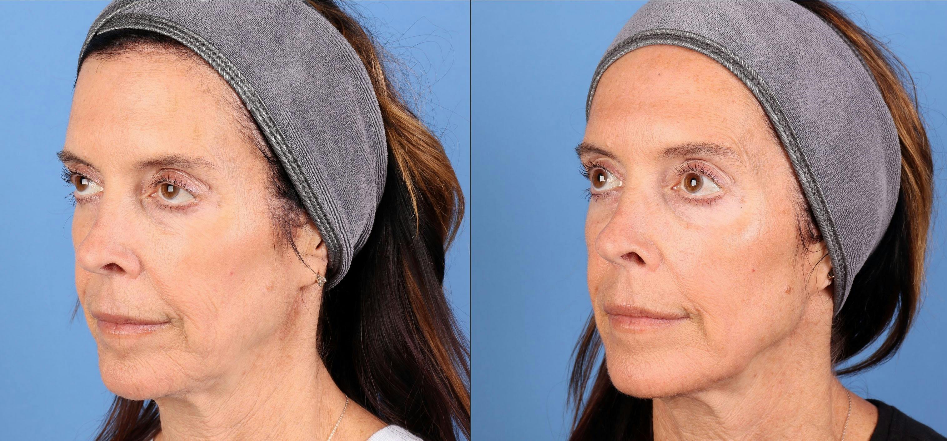 Laser Treatments Before & After Gallery - Patient 394617 - Image 3