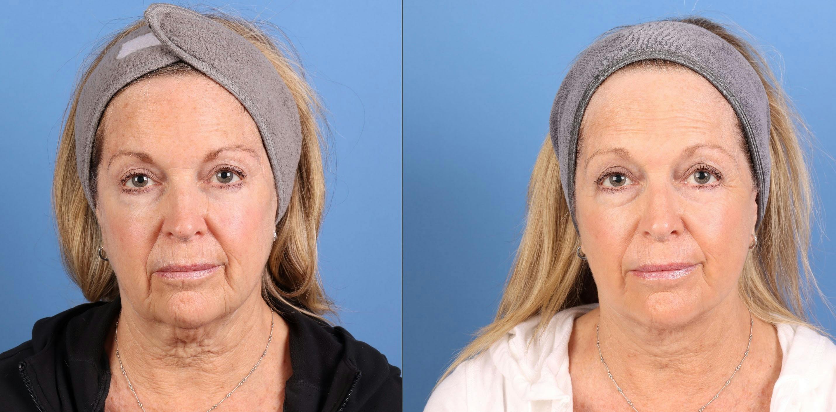 Contour TRL Laser Before & After Gallery - Patient 101164 - Image 2