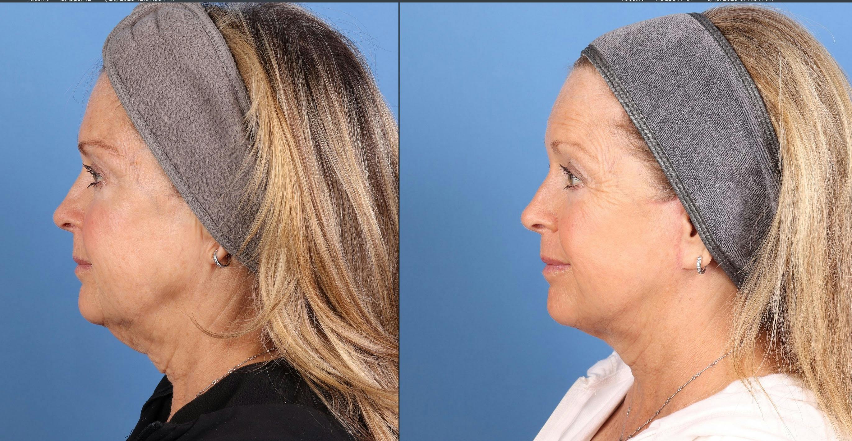 Contour TRL Laser Before & After Gallery - Patient 101164 - Image 5