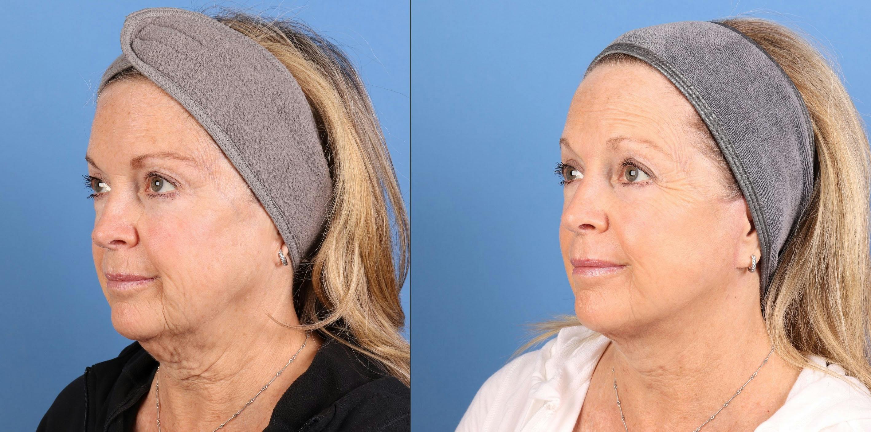 Contour TRL Laser Before & After Gallery - Patient 101164 - Image 1