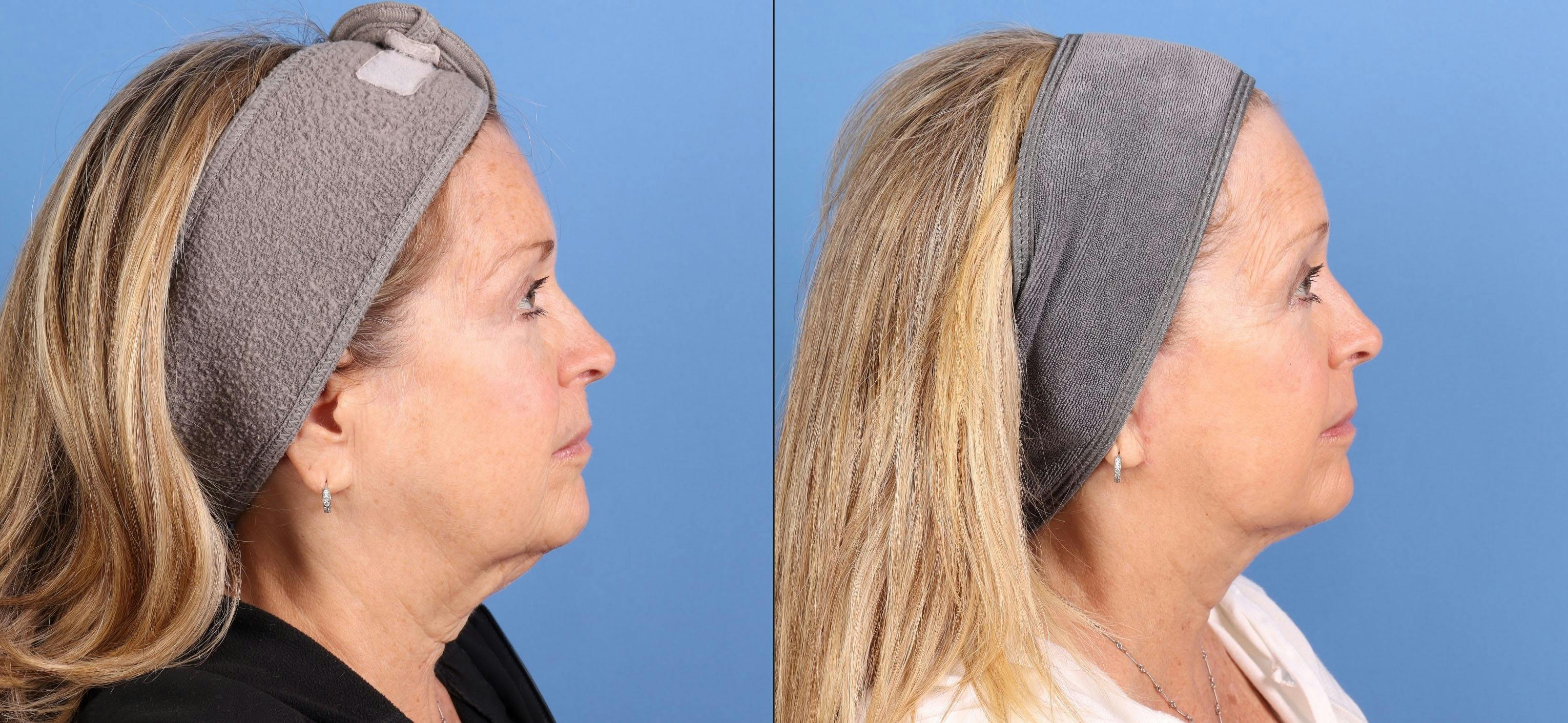 Contour TRL Laser Before & After Gallery - Patient 101164 - Image 4