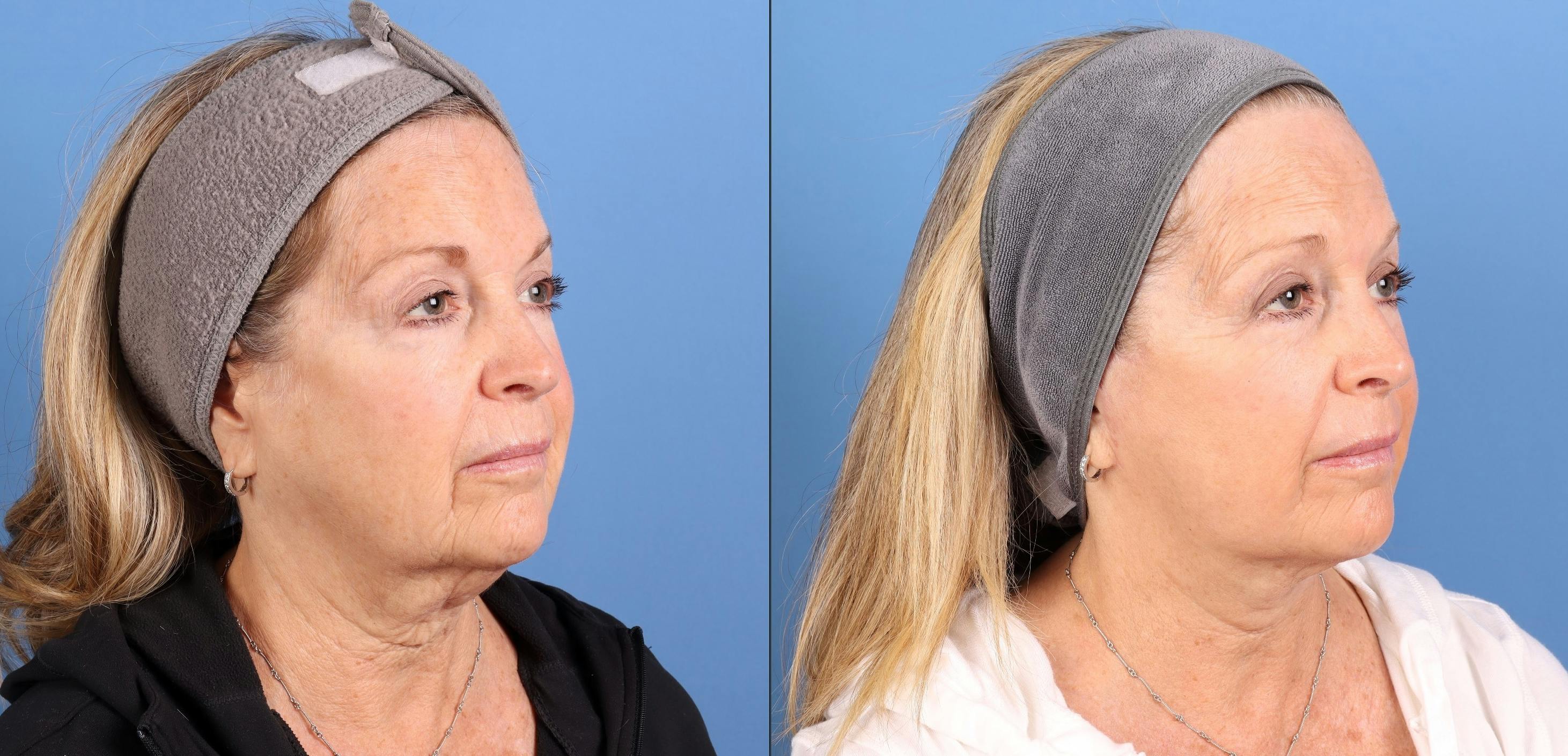 Contour TRL Laser Before & After Gallery - Patient 101164 - Image 3