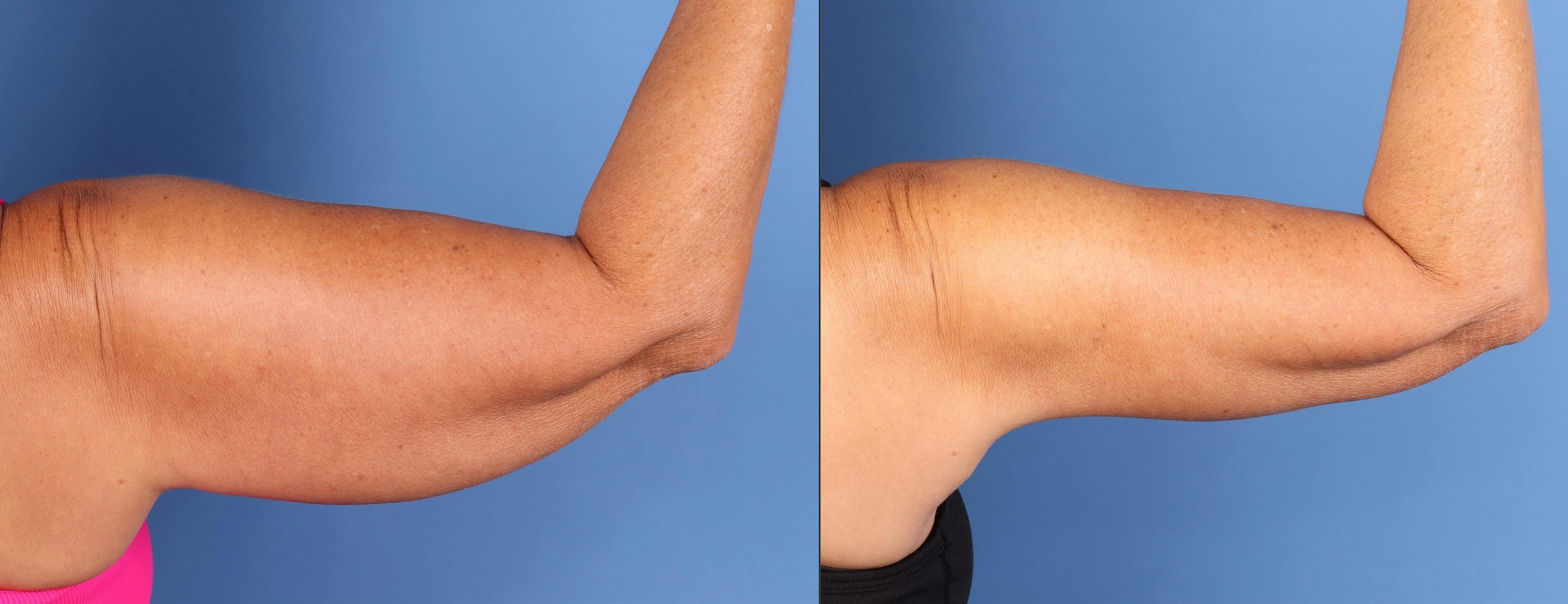 Arm Lift Before & After Gallery - Patient 202521 - Image 3