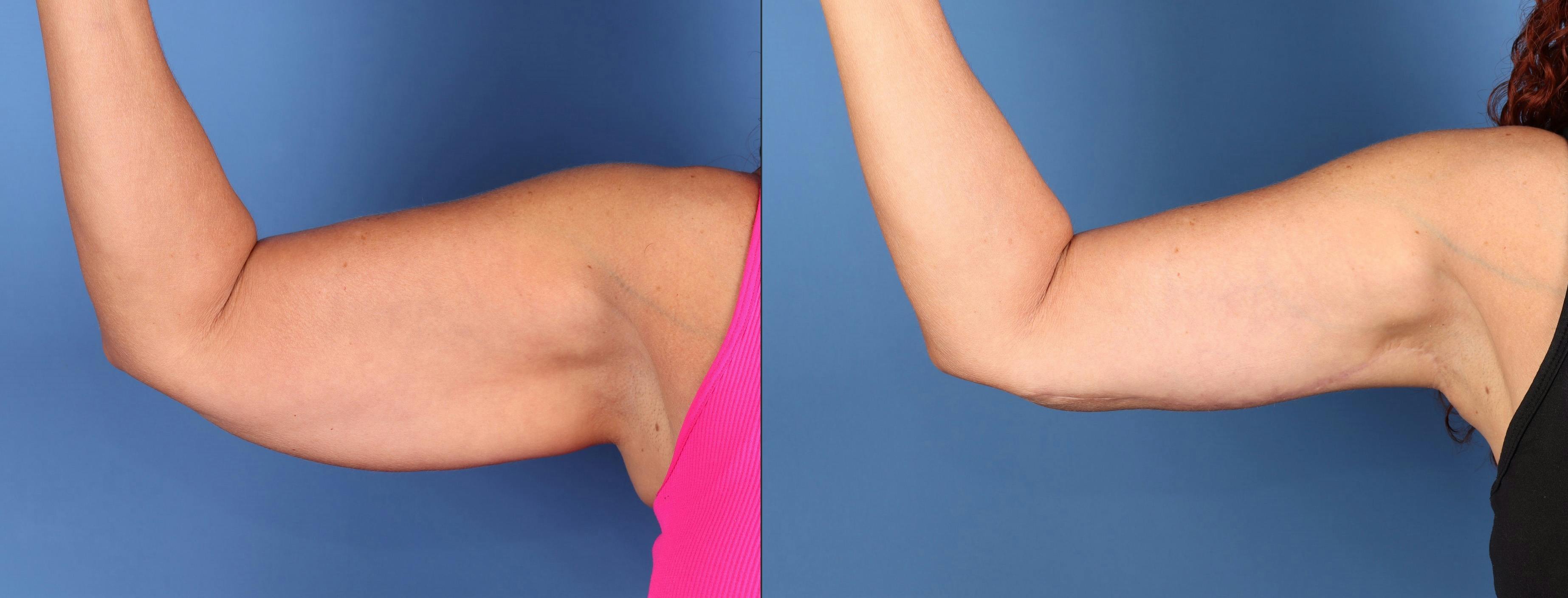 Arm Lift Before & After Gallery - Patient 202521 - Image 2