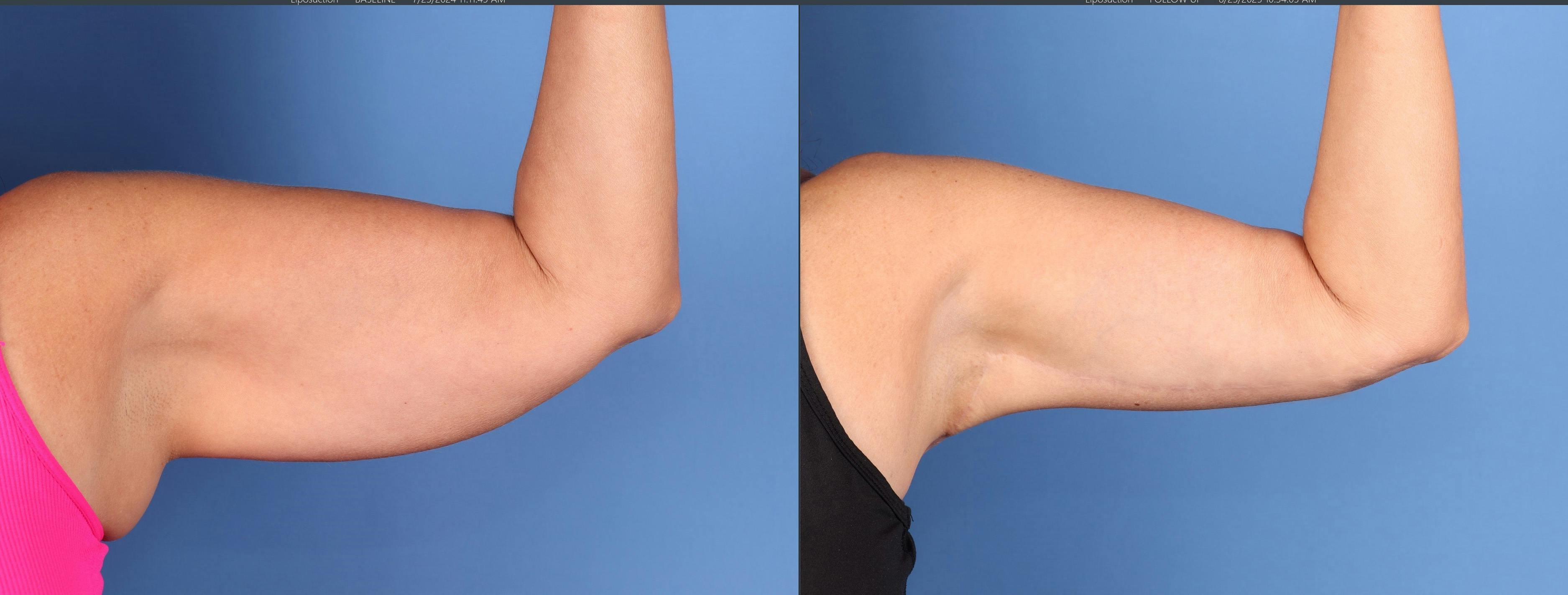 Arm Lift Before & After Gallery - Patient 202521 - Image 4