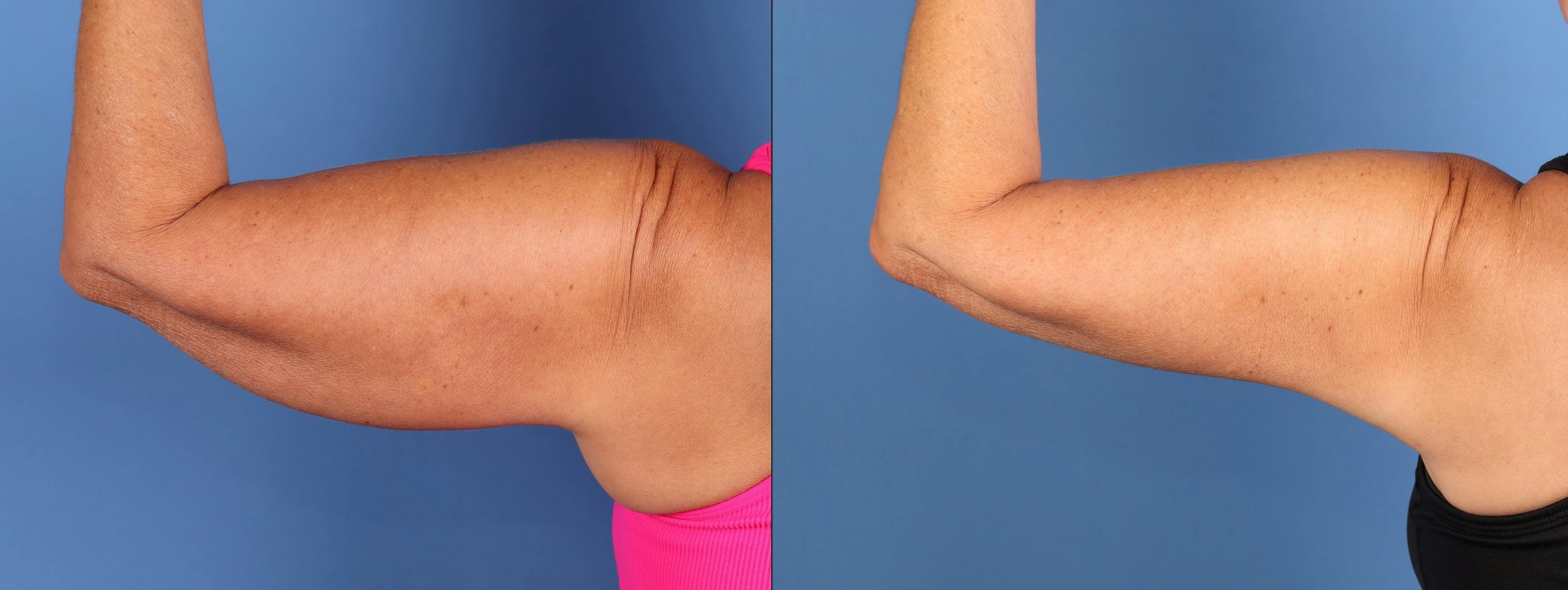 Arm Lift Before & After Gallery - Patient 202521 - Image 1