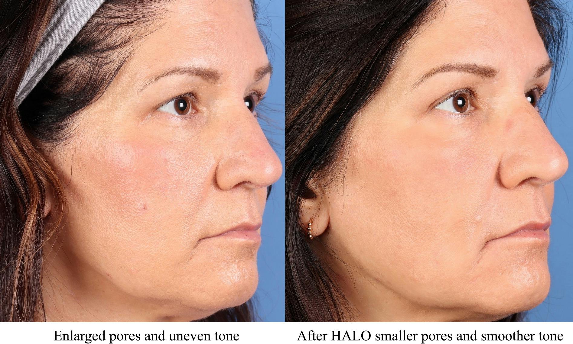 Laser Treatments Before & After Gallery - Patient 368435 - Image 1