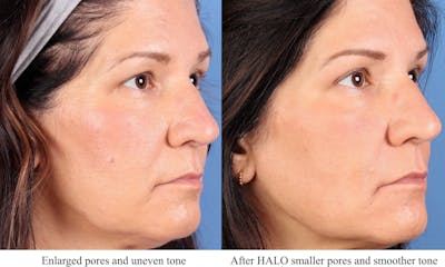 Laser Treatments Before & After Gallery - Patient 368435 - Image 1