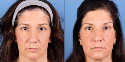 Eyelid Surgery (Upper Blepharoplasty) Before & After Gallery - Patient 148798 - Image 1