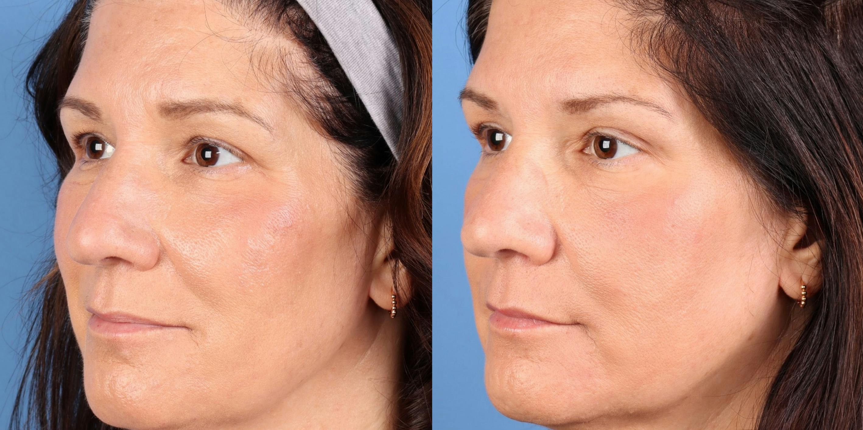 Laser Treatments Before & After Gallery - Patient 368435 - Image 3