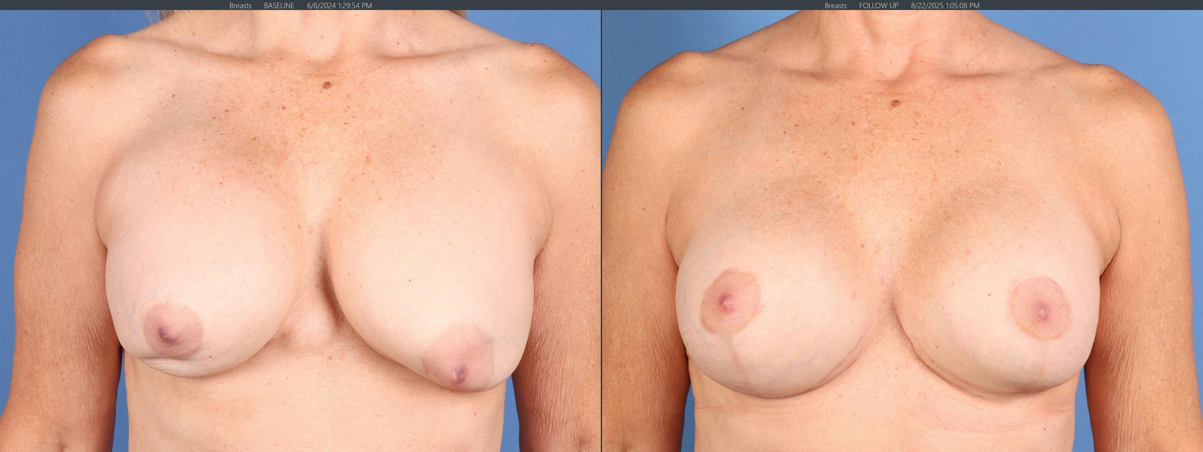 Breast Revision Before & After Gallery - Patient 240522 - Image 1