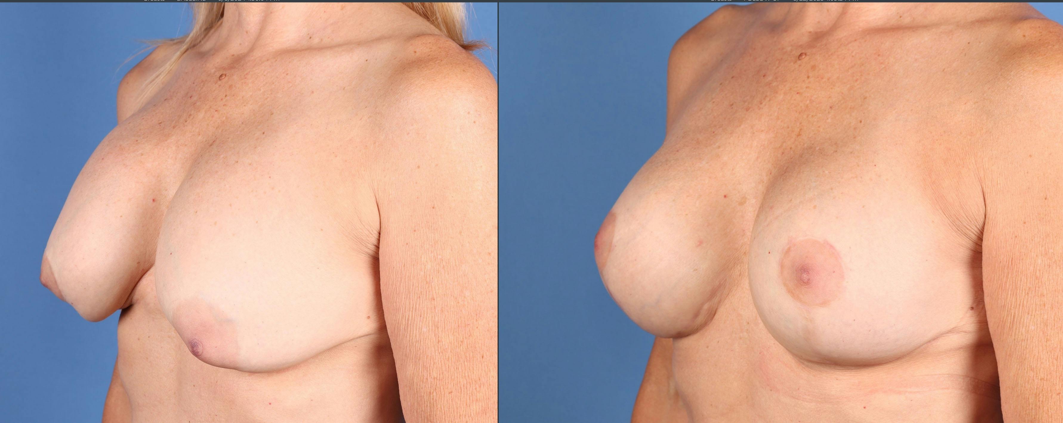 Breast Revision Before & After Gallery - Patient 240522 - Image 2