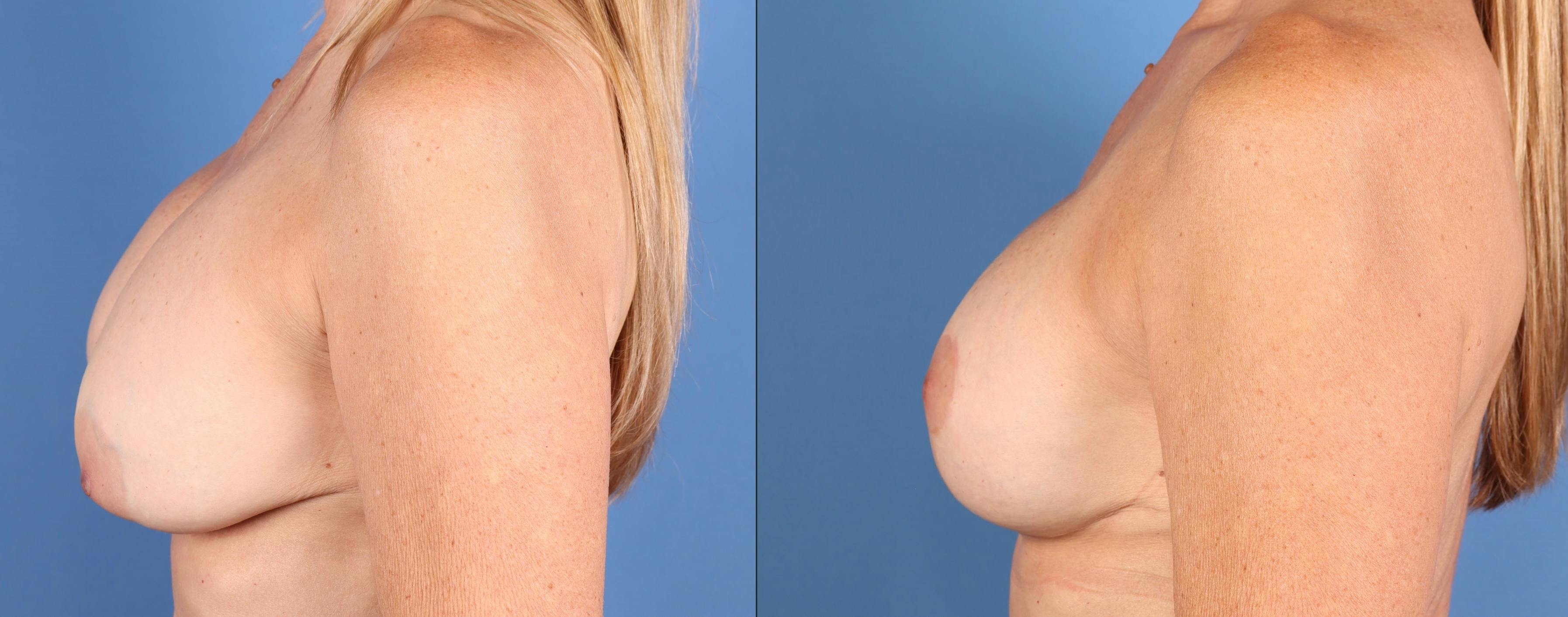 Breast Revision Before & After Gallery - Patient 240522 - Image 3