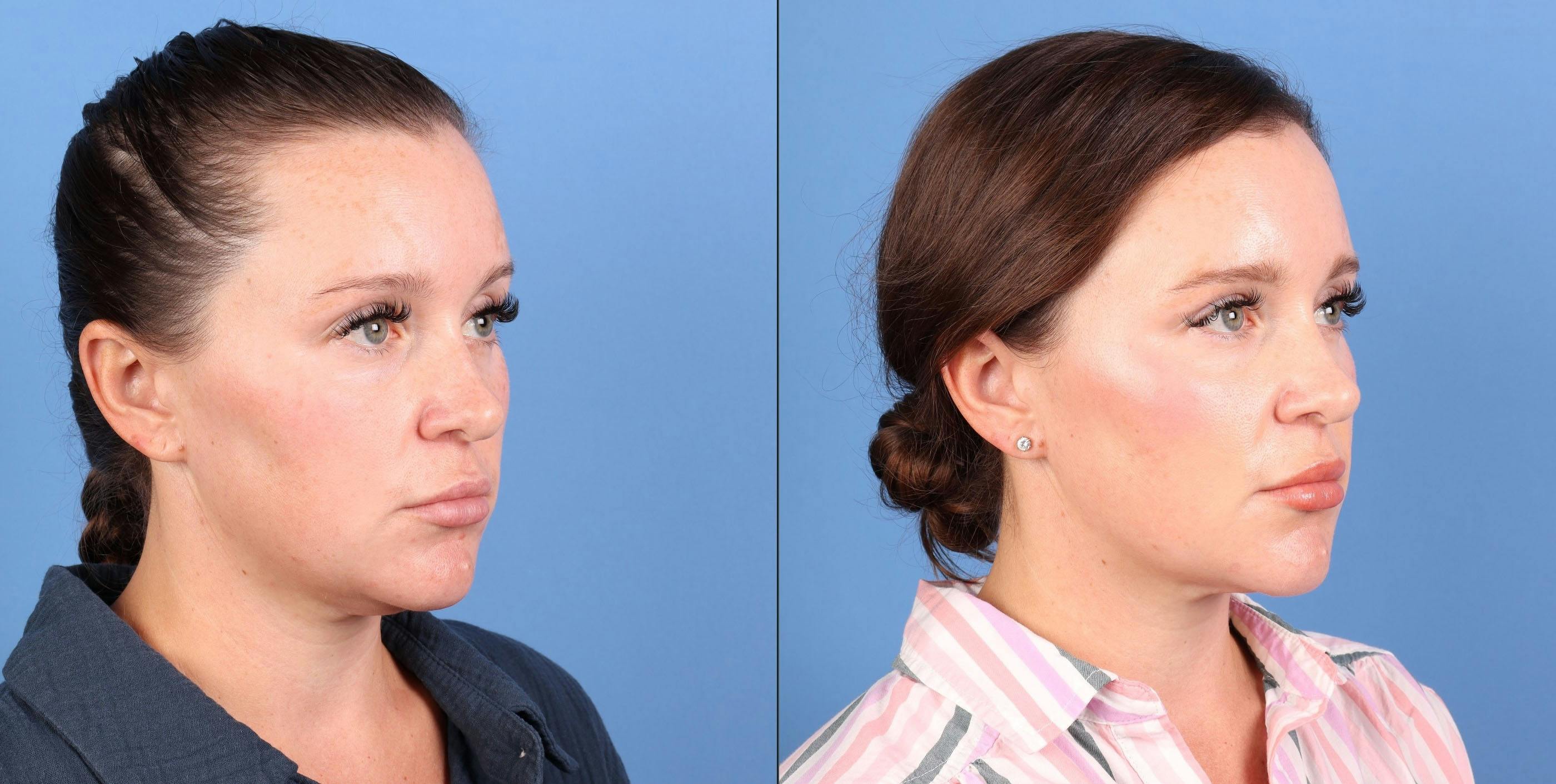 Face & Neck Before & After Gallery - Patient 365395 - Image 3