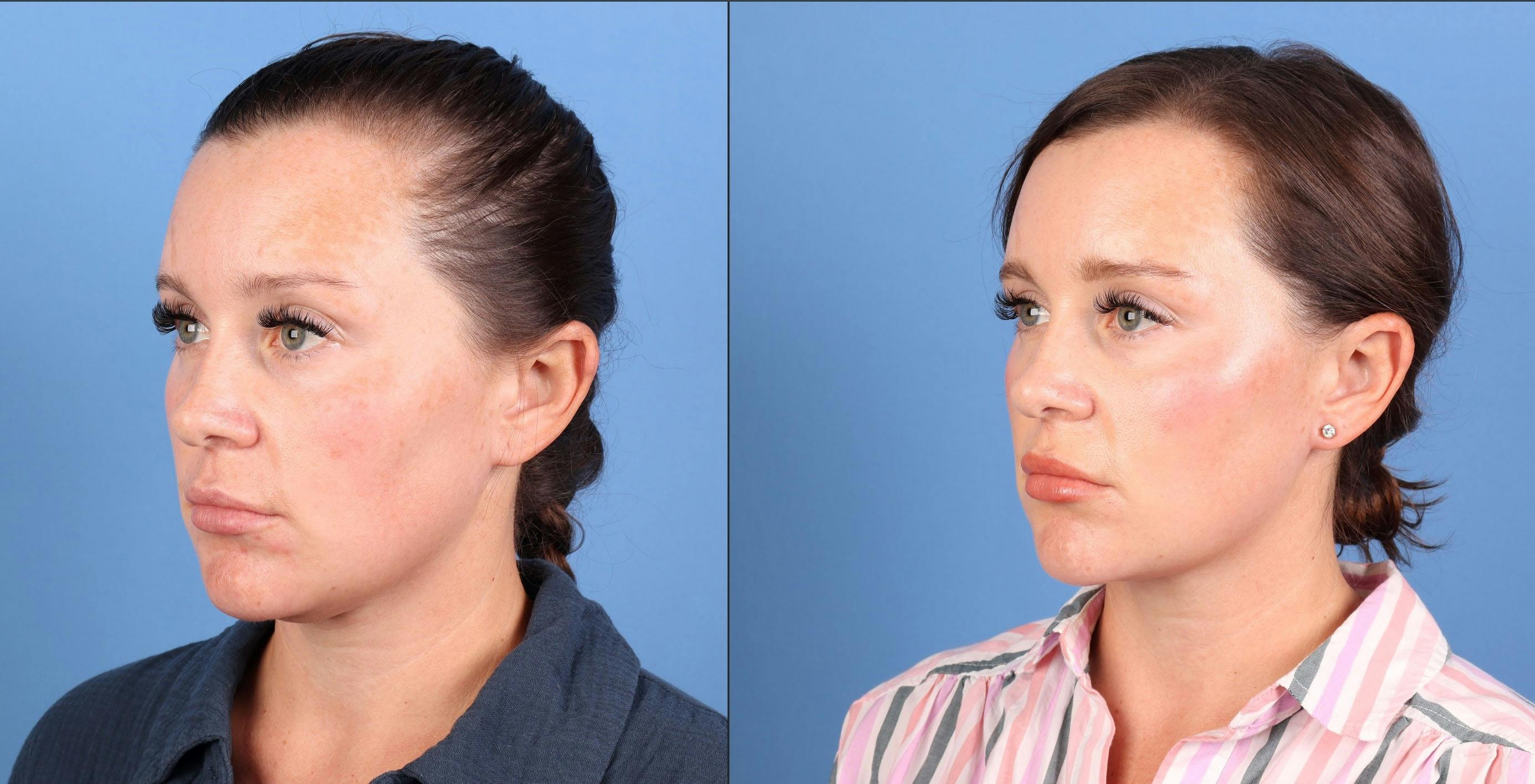 Face & Neck Before & After Gallery - Patient 365395 - Image 1