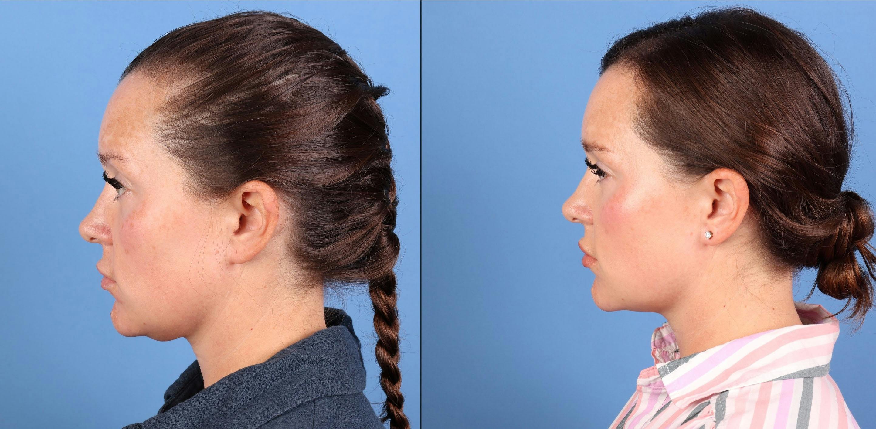 Face & Neck Before & After Gallery - Patient 365395 - Image 2