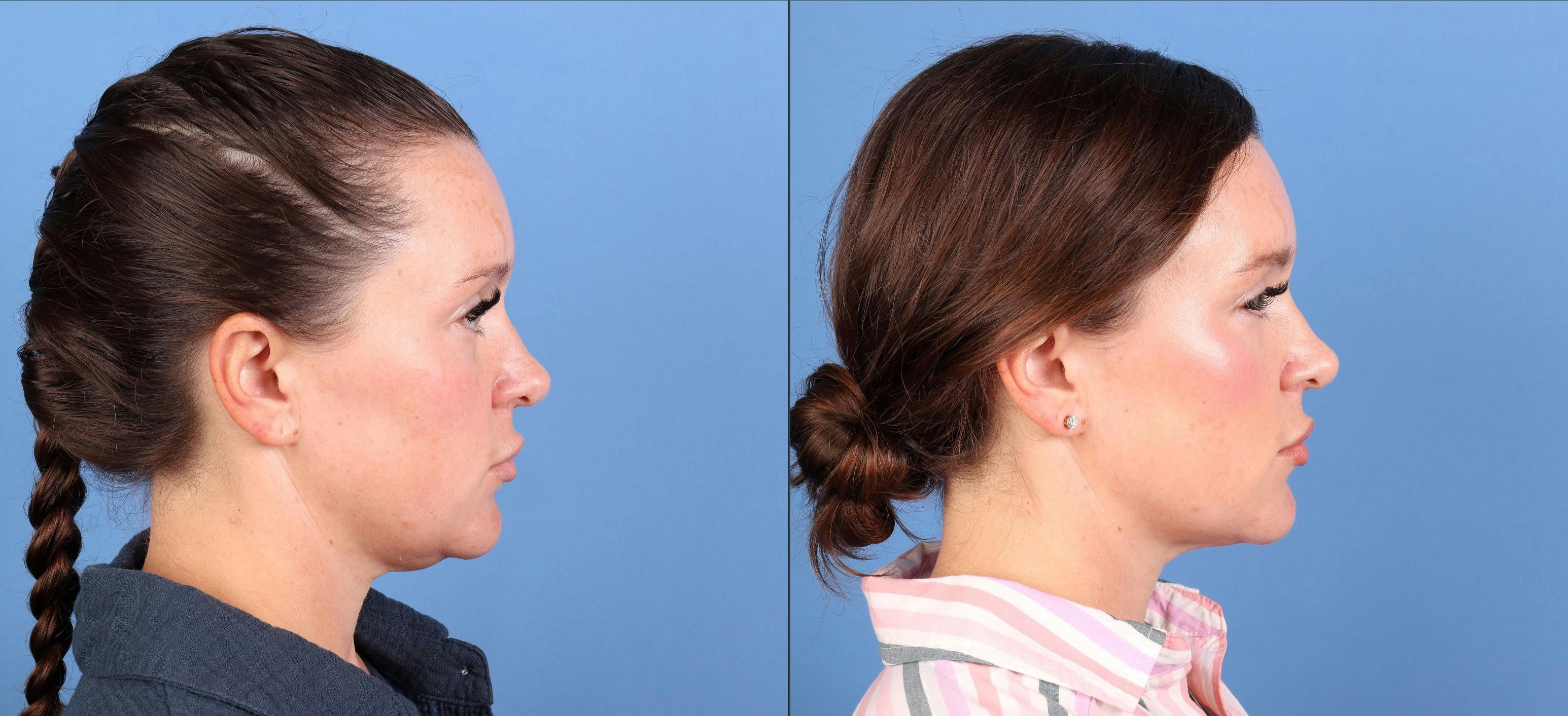 Face & Neck Before & After Gallery - Patient 365395 - Image 4