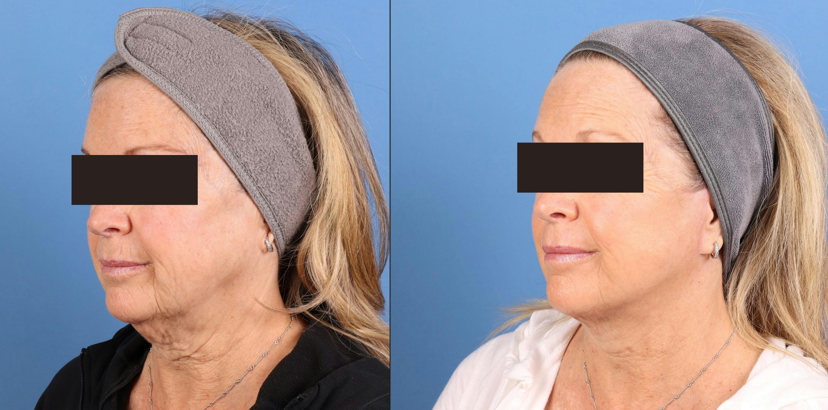 Face Lift Before & After Gallery - Patient 910000 - Image 1