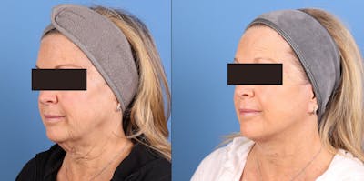 Face Lift Before & After Gallery - Patient 910000 - Image 1
