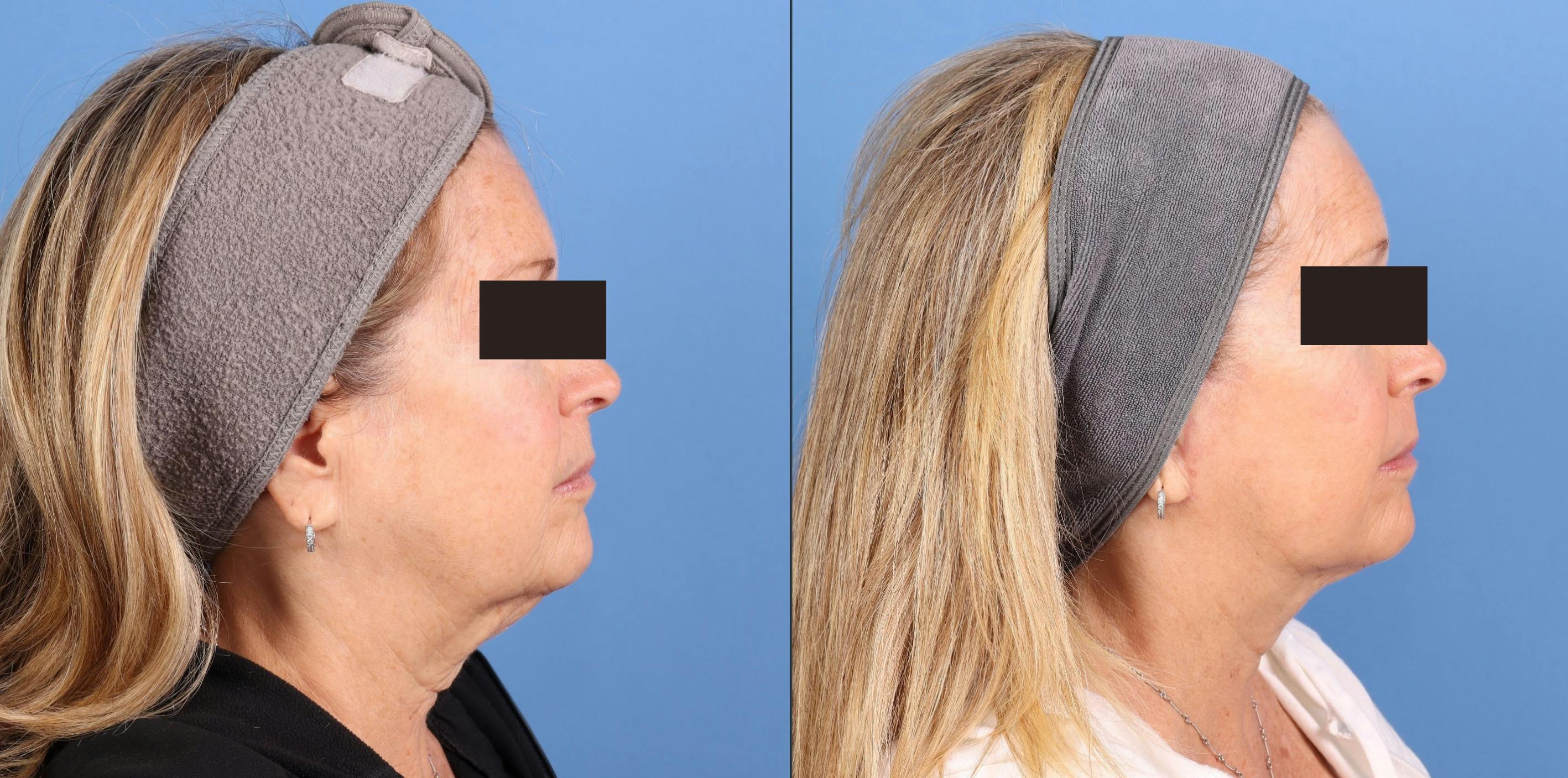 Face Lift Before & After Gallery - Patient 910000 - Image 4