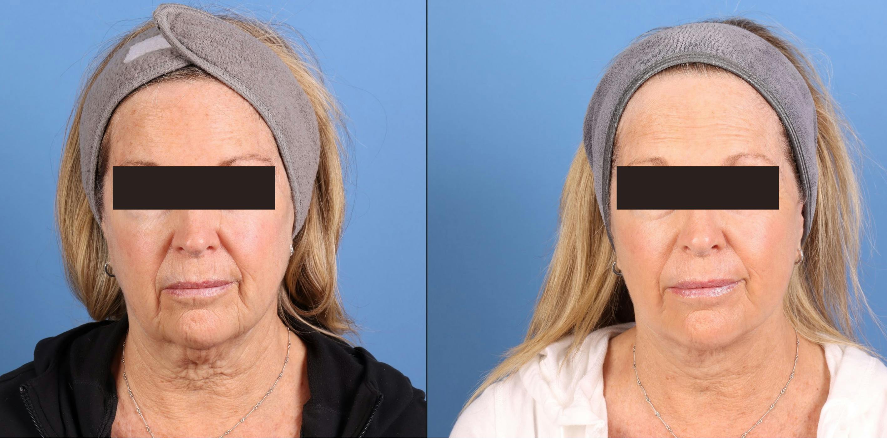Face Lift Before & After Gallery - Patient 910000 - Image 2