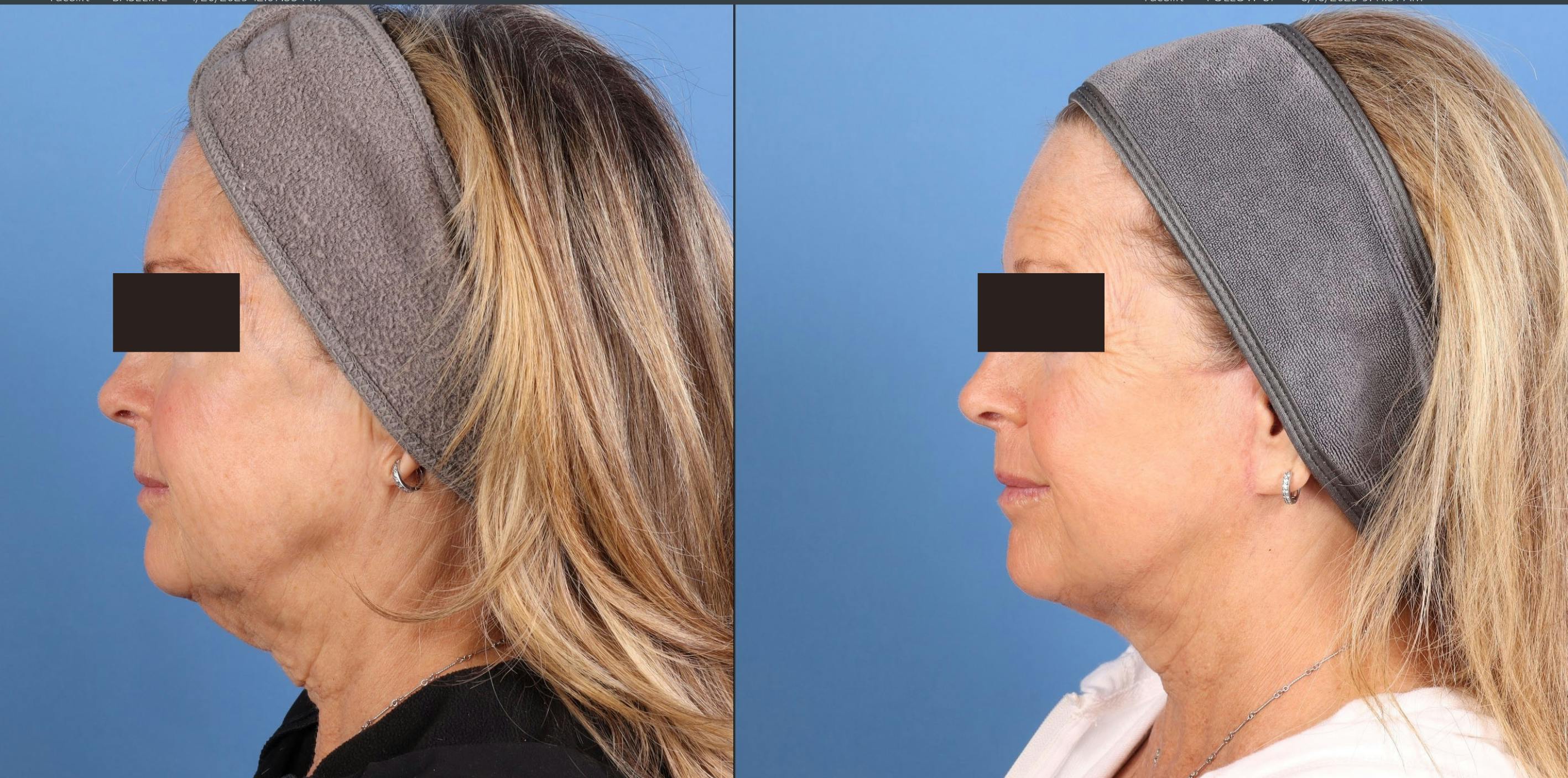 Face Lift Before & After Gallery - Patient 910000 - Image 5