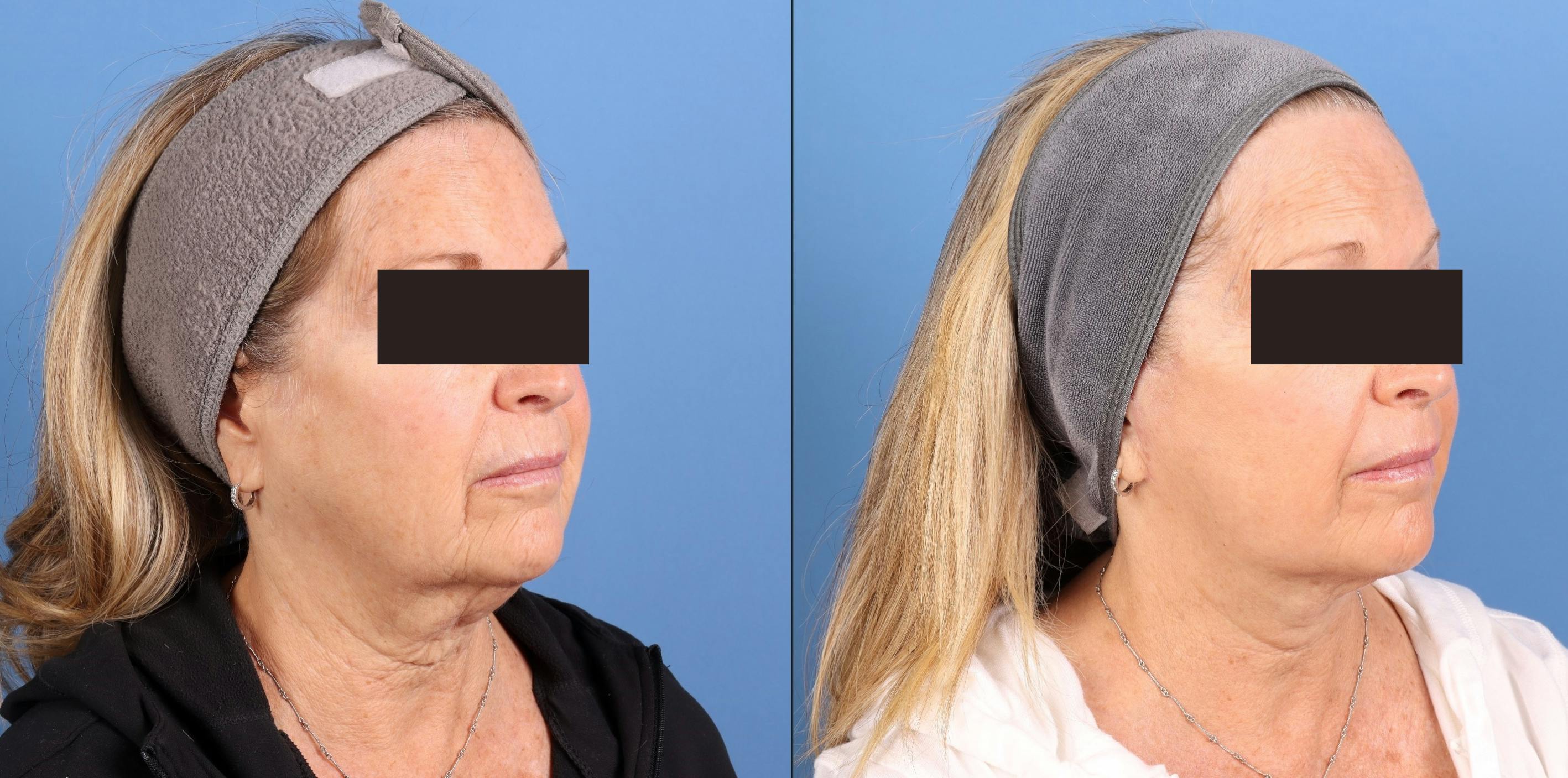 Face Lift Before & After Gallery - Patient 910000 - Image 3