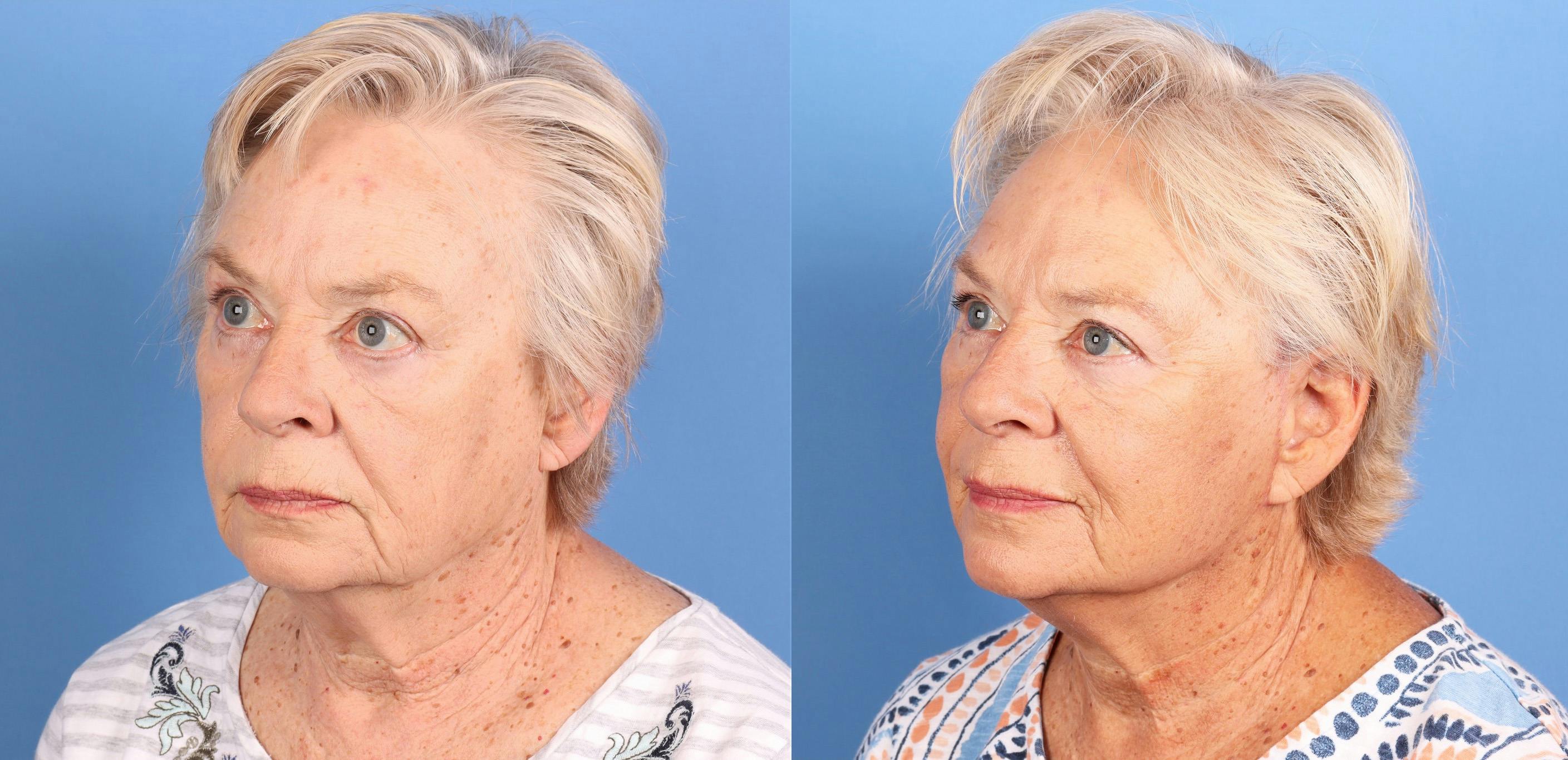 Mini Facelift Before & After Gallery - Patient 227829 - Image 1