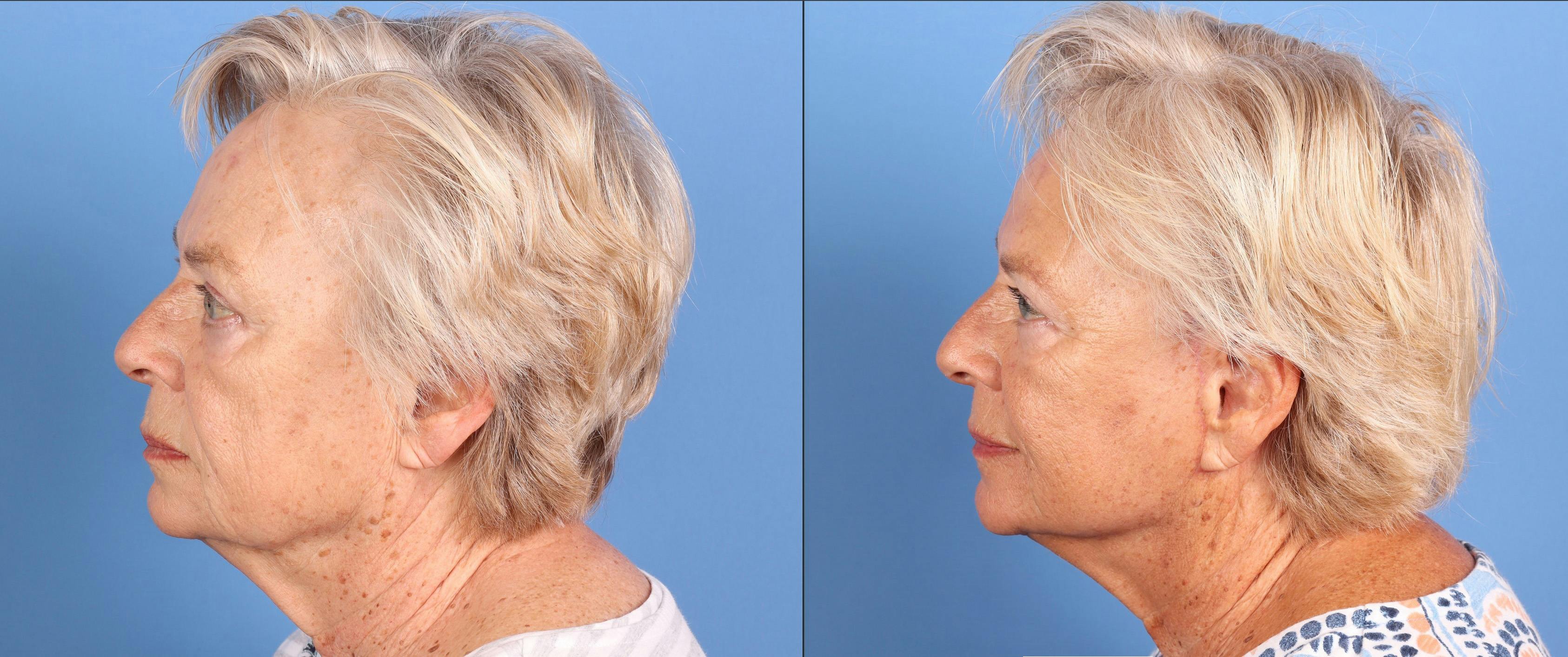 Mini Facelift Before & After Gallery - Patient 227829 - Image 2