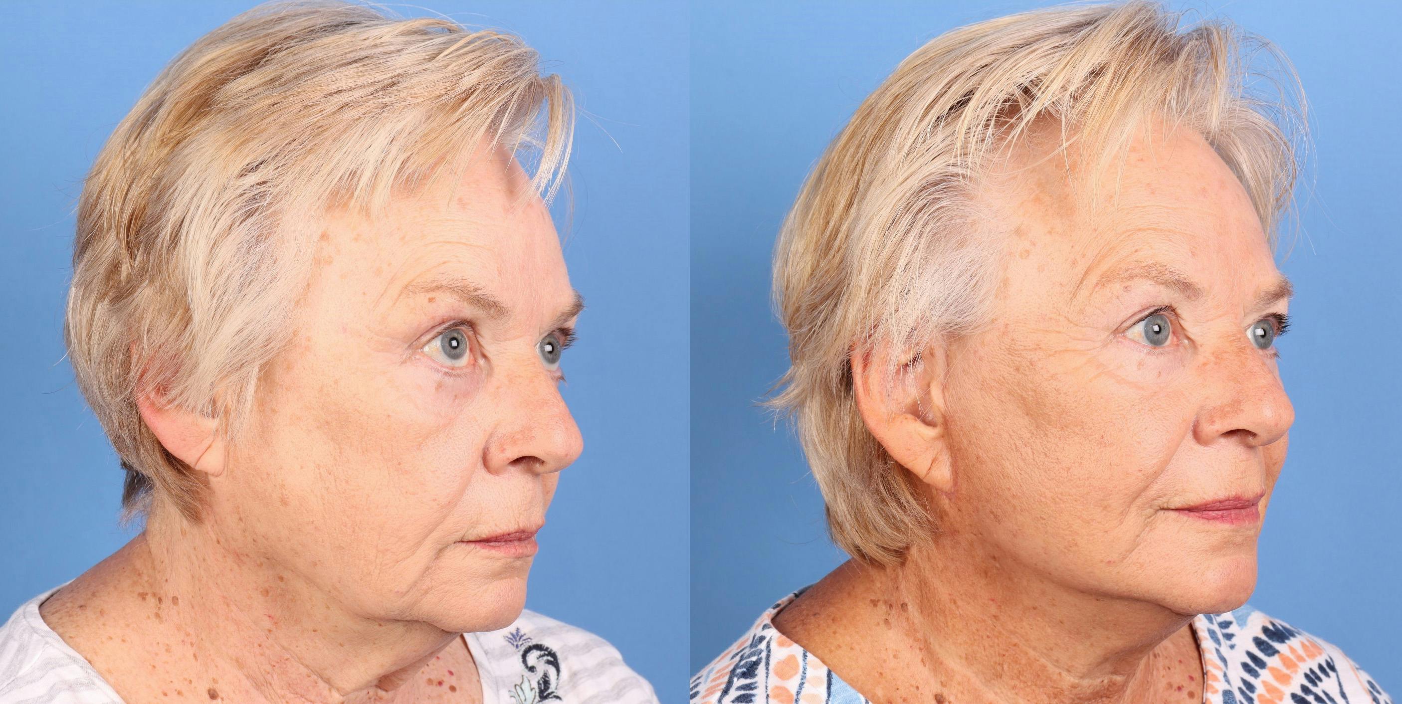Mini Facelift Before & After Gallery - Patient 227829 - Image 3
