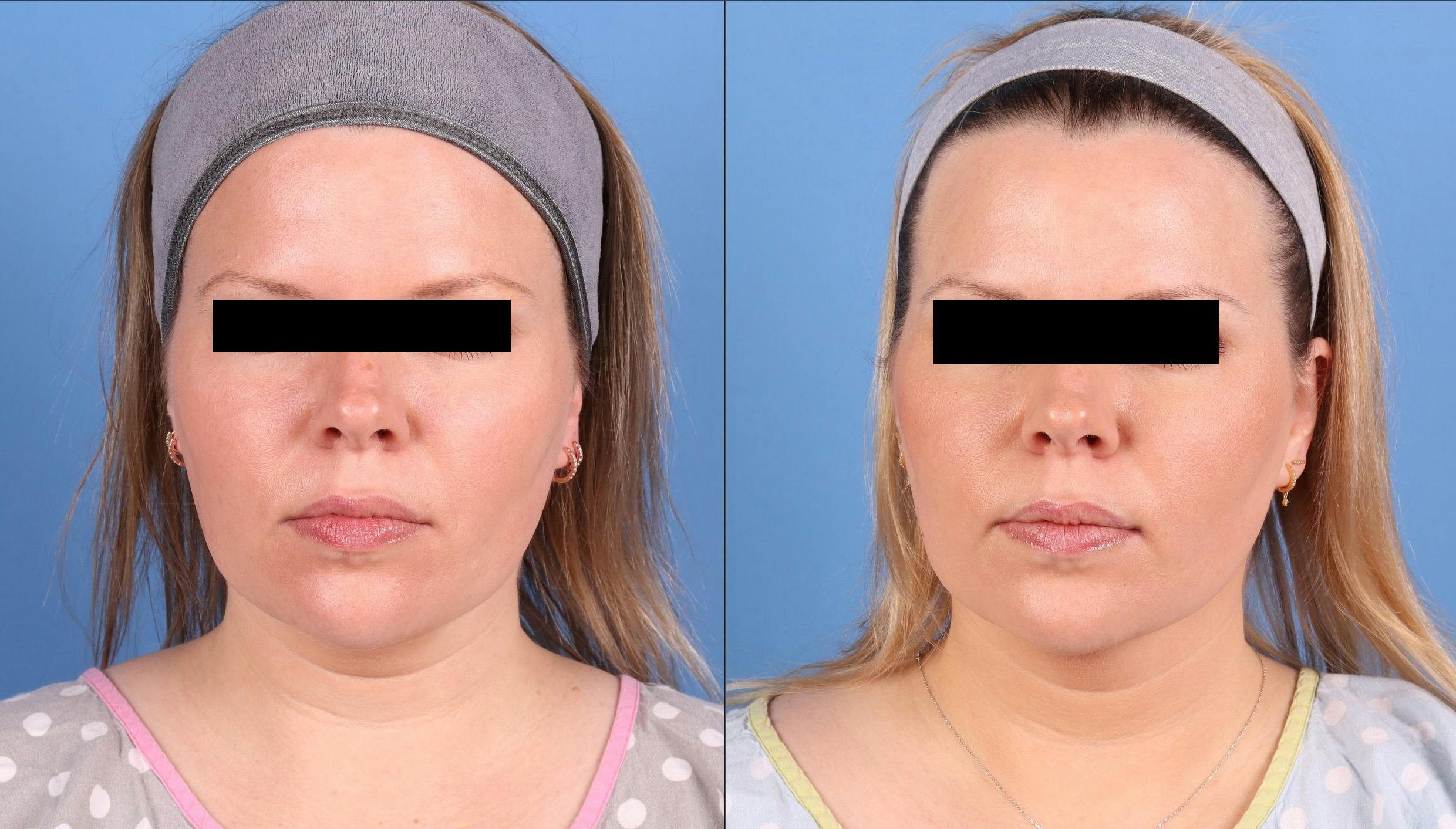 Face & Neck Before & After Gallery - Patient 562046 - Image 1