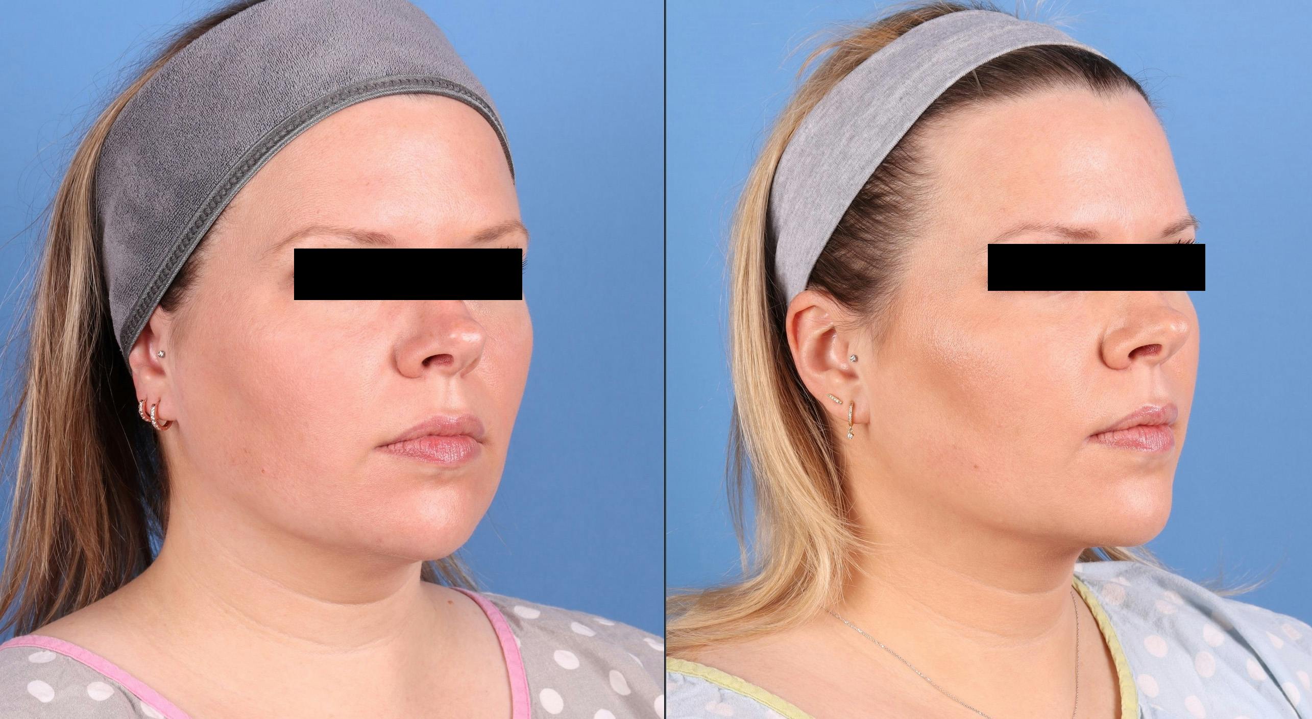 Face & Neck Before & After Gallery - Patient 562046 - Image 2