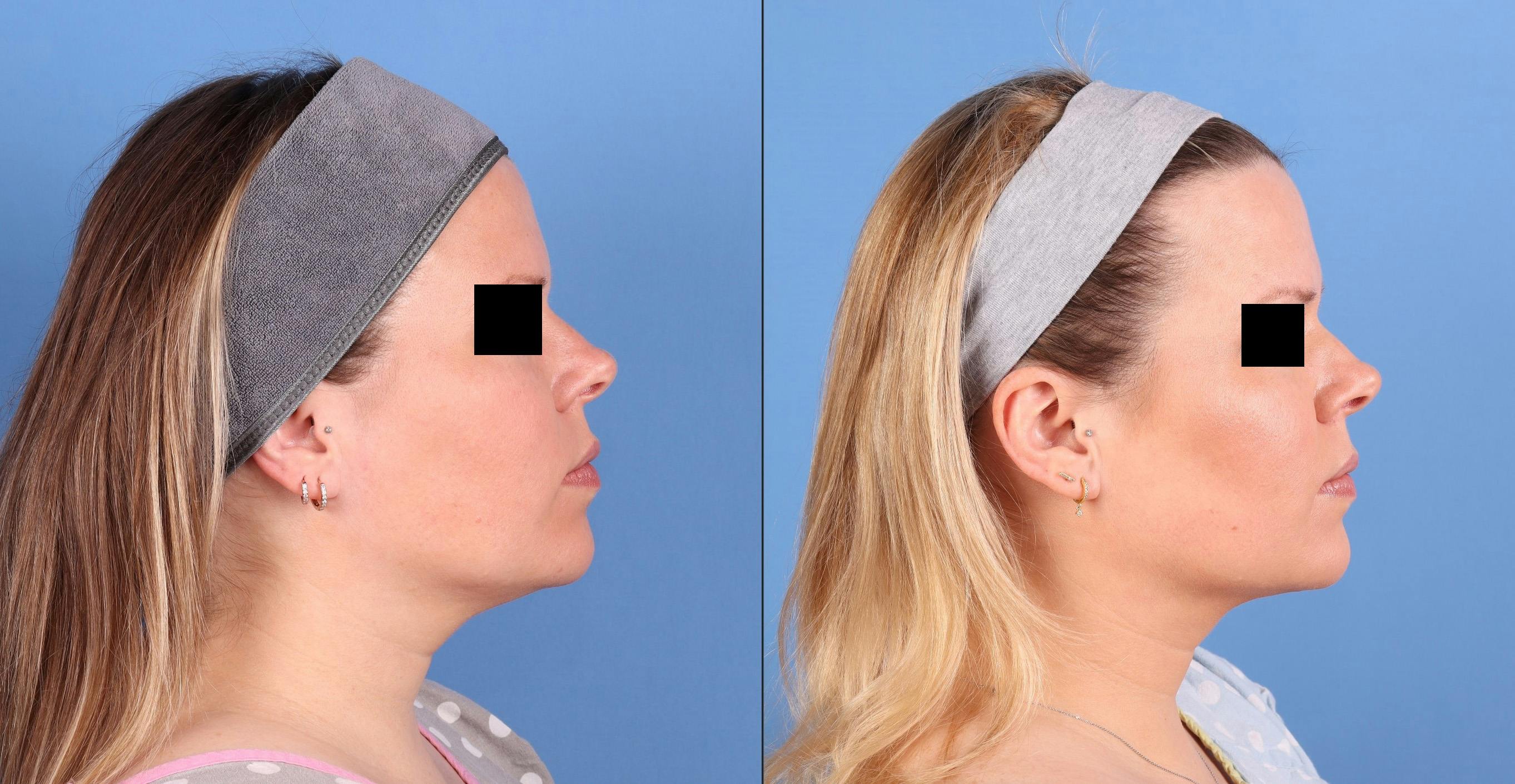 Face & Neck Before & After Gallery - Patient 562046 - Image 3
