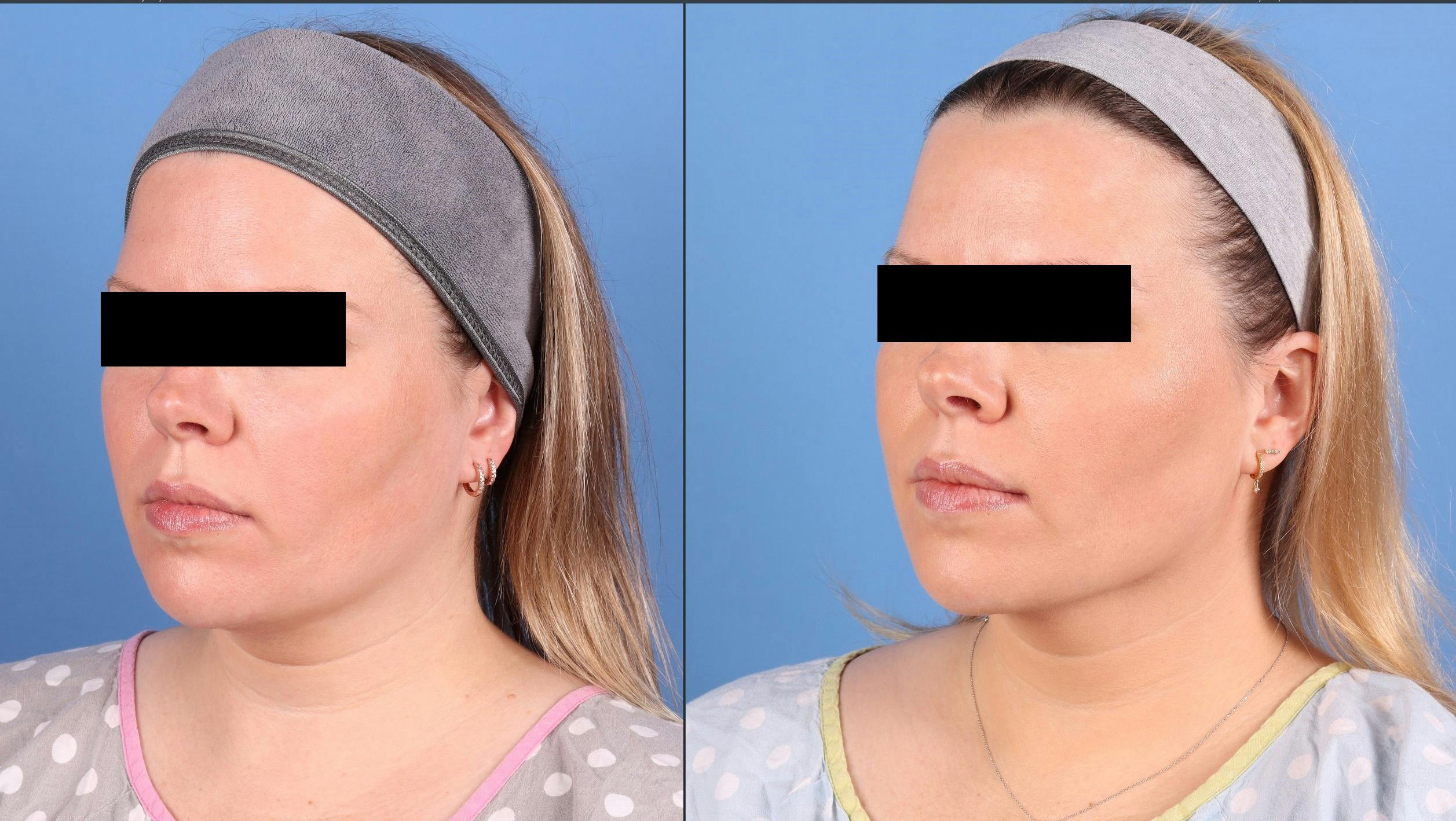 Face & Neck Before & After Gallery - Patient 562046 - Image 4