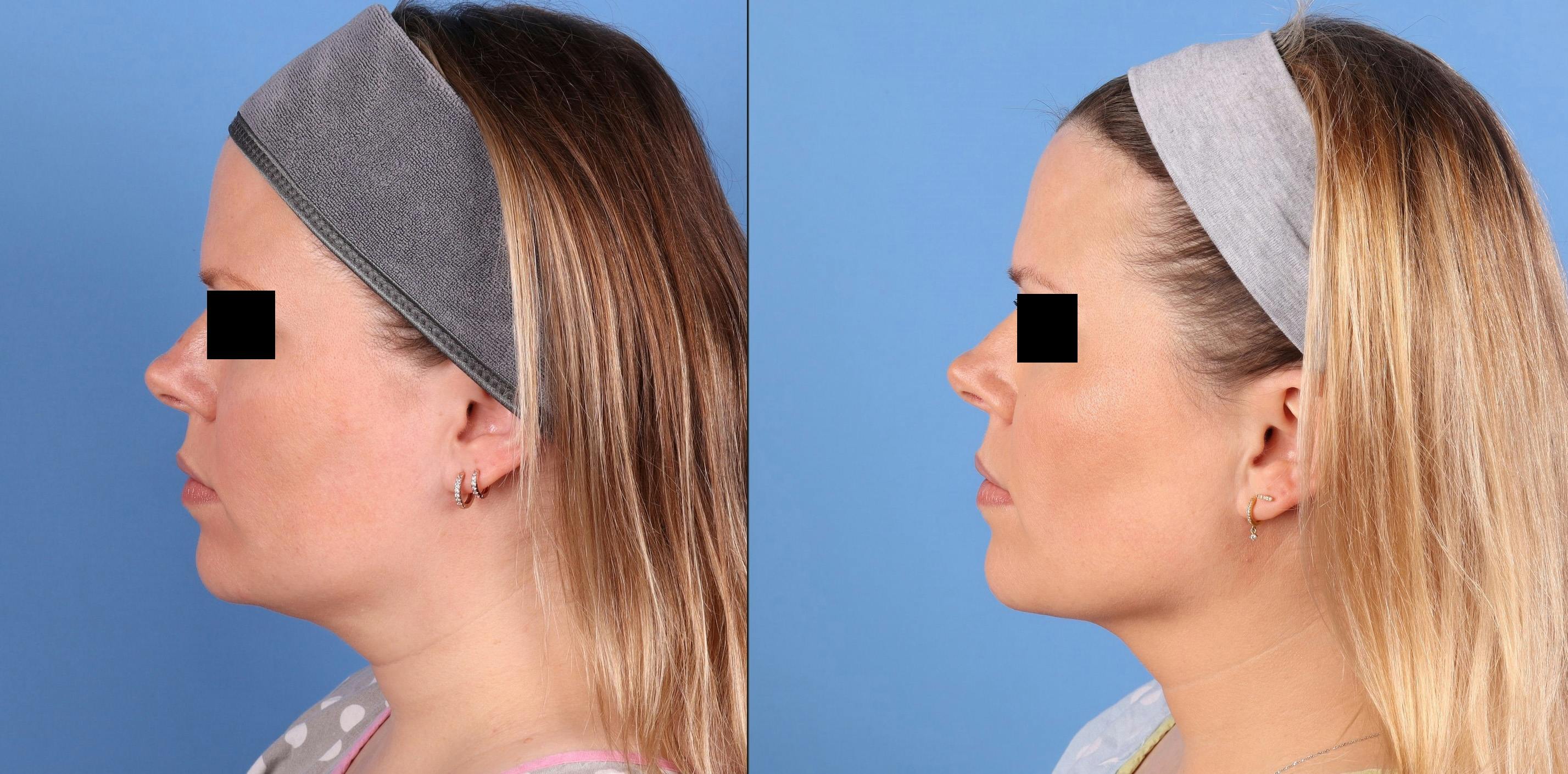 Face & Neck Before & After Gallery - Patient 562046 - Image 5